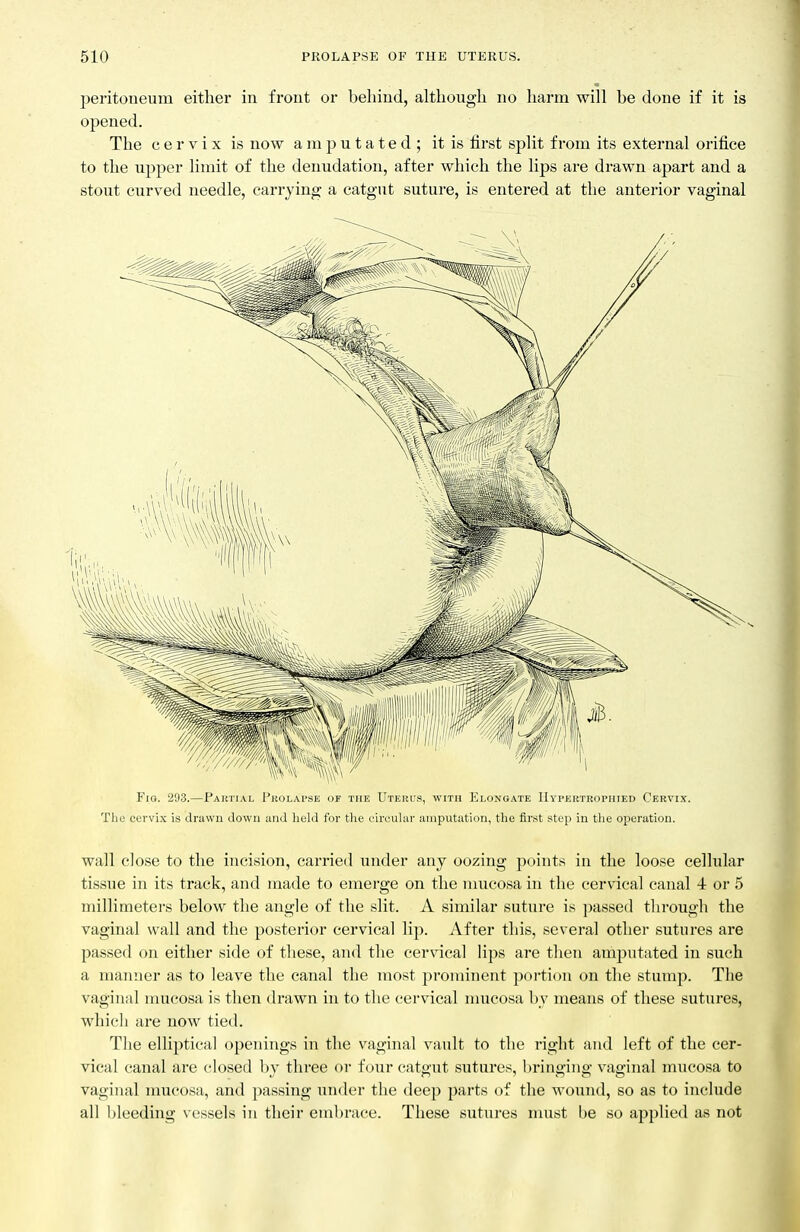 peritoueum either in front or behind, although no harm will be done if it is opened. The cervix is now amputated; it is first split from its external orifice to the upper limit of the deimdation, after which the lips are drawn apart and a stout curved needle, cari'jing a catgut suture, is entered at the anterior vaginal Fig. 2!)3.—Partial Prolapse of the Uterus, with Elongate IIypertrophied Cervix. Tlic cervix is drawn down and lield for tlie ciivular amputation, the first step in the operation. wall close to the incision, carried under any oozing points in the loose cellular tissue in its track, and made to emerge on the nmcosa in the cervical canal 4 or 5 millimetei-s below the angle of the slit. A similar suture is passed through the vaginal wall and the posterior cervical lip. After this, several other sutures are passed on either side of these, and the cervical lips are then amputated in such a manner as to leave the canal the most prominent portion on the stump. The vaginal mucosa is then drawn in to the cervical nmcosa bv means of these sutures, which are now tied. The elliptical openings in the vaginal vault to the right and left of the cer- vical canal are closed by three or four catgut sutures, bringing vaginal mucosa to vaginal mucosa, and passing under the deep parts of the wound, so as to include all bleeding vessels in their embrace. These sutures must he so applied as not