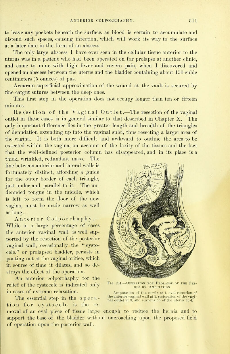 to leave any pockets beneath the surface, as blood is certain to accumulate and distend such spaces, causing infection, which will work its way to the surface at a later date in the form of an abscess. The only large abscess I have ever seen in the cellular tissue anterior to the uterus was in a patient who had been operated on for pro]aj)se at another clinic, and came to mine with high fever and severe pain, when I discovered and opened an abscess between the uterus and the bladder containing about 150 cubic centimeters (5 ounces ) of pus. Accurate superficial approximation of the wound at the vault is secured by fine catgut sutures between the deep ones. This first step in the operation does not occupy longer than ten or fifteen minutes. Resection of the Vaginal Outlet.—The resection of the vaginal outlet in these cases is in general similar to that described in Chapter X. The only important difference lies in the greater length and breadth of the triangles of denudation extending up into the vaginal sulci, thus resecting a larger area of the vagina. It is both more difficult and awkward to outline the area to be exsected within the vagina, on account of the laxity of the tissues and the fact that the well-defined posterior column has disappeared, and in its place is a thick, wrinkled, redundant mass. The line between anterior and lateral walls is fortunately distinct, affording a guide for the outer border of each triangle, just under and parallel to it. The un- denuded tongue in the middle, which is left to form the floor of the new vagina, must l)e made narrow as well as long. Anterior C o 1 p o r r h a p h y.— While in a large jiercentage of cases the anterior vaginal wall is well sup- ported by the resection of the posterior vaginal wall, occasionally the  cysto- cele, or prolapsed bladder, persists in pouting out at the vaginal orifice, which in course of time it dilates, and so de- stroys the effect of the operation. An anterior colporrhaphy for the relief of the cystocele is indicated only in cases of extreme relaxation. The essential step in the opera- tion for cystocele is the re- moval of an oval piece of tissue large enough to reduce the hernia and to support the base of the bladder without encroaching upon the proposed field of operation upon the posterior wall. Fig. 294.—Operation for Prolai-sk of the Ute- ri's BY Amputation Amputation of the cervix at 1, oval resection of the anterior vaginal wall at '2, restoration of the vagi- nal outlet at 3, and suspension of tliv uterus at 4.
