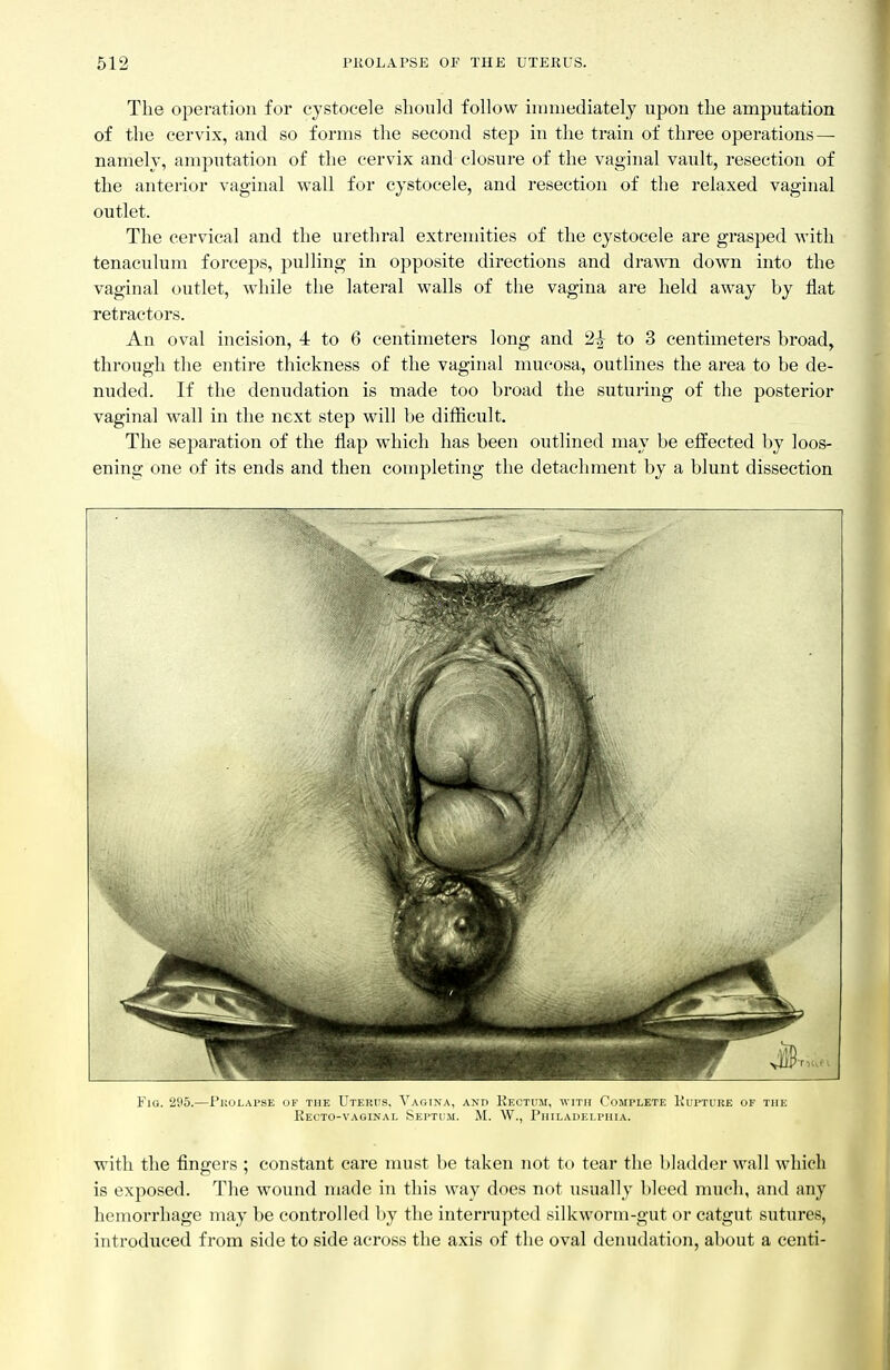 The operation for cystocele should follow immediately upon the amputation of the cervix, and so forms the second step in the train of three operations — namely, amputation of the cervix and closure of the vaginal vault, resection of the anterior vaginal wall for cystocele, and resection of the relaxed vaginal outlet. The cervical and the urethral extremities of the cystocele are grasped with tenaculum forceps, pulling in opposite directions and dra-wn down into the vaginal outlet, while the lateral walls of the vagina are held away by flat retractors. An oval incision, 4 to 6 centimeters long and 2^ to 3 centimeters broad, through the entire thickness of the vaginal mucosa, outlines the area to be de- nuded. If the denudation is made too broad the suturing of the posterior vaginal wall in the next step will be difficult. The separation of the flap which has been outlined may be effected by loos- ening one of its ends and then completing the detachment by a blunt dissection Fig. 205.—Pi:olai-se of the Uterus, Vagina, and Kectcm, ■with Complete Rupture of the Recto-vaginal Septum. M. W., Philadelphia. with the fingers ; constant care must be taken not to tear the bladder wall which is exposed. The wound made in this way does not usually bleed much, and any hemorrhage may be controlled by the interrupted silkworm-gut or catgut sutures, introduced from side to side across the axis of the oval denudation, about a centi-