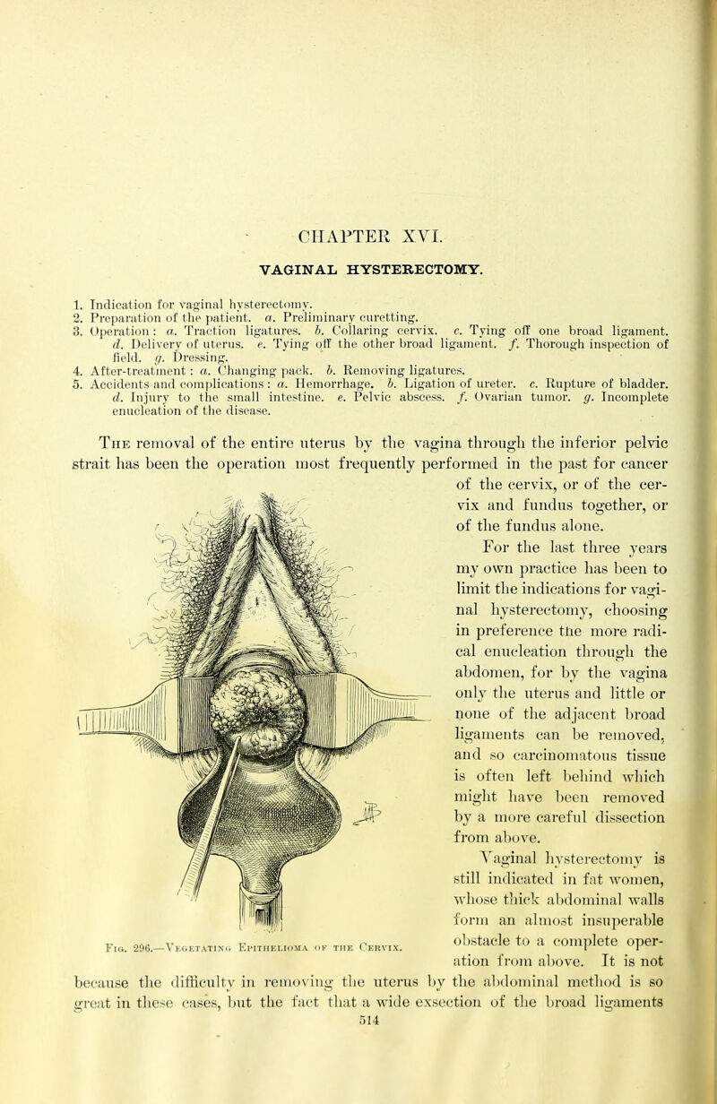 CHAPTER XVI. VAGINAL HYSTERECTOMY. 1. Indication for vaginal hysterectomy. 3. Preparation of the patient, a. Preliminary curetting. 3. Operation : a. Traction ligatures, b. Collaring cervix, c. Tying off one broad ligament. d. Delivery of uterus, e. Tying oft the other broad ligament. /. Thorough inspection of field, g. Dressing. 4. After-treatment: a. Changing pack. h. Removing ligatures. 5. Accidents and complications : a. Hemorrhage, h. Ligation of ureter, c. Rupture of bladder. d. Injury to the small intestine, e. Pelvic abscess. /. Ovarian tumor, g. Incomplete enucleation of the disease. The removal of the entire uterus by the vagina through the inferior pelvic strait has been the operation most frequently performed in the past for cancer of the cervi.x, or of the cer- vix and fundus together, or of the fundus alone. For the last three years my own practice has been to limit the indications for vagi- nal hysterectomy, choosing in preference tlie more radi- cal enucleation through the abdomen, for by the vagina only the uterus and little or none of the adjacent l)road ligaments can be removed, and so carcinomatous tissue is often left l)eliind which might have been removed by a more careful dissection from al)ove. A''aginal hysterectomy is still indicated in fat women, whose thick aI)dominal walls foi-m an almost insuperable obstacle to a complete oper- ation from above. It is not because the difficulty in i-emoving tlie uterus l)y the abdominal method is so great in these cases, but the fact that a wide exsection of tlic broad lig-aments Fig. 29G.—Vkoetating EiTriim.io.vA ok the Of.uvix.