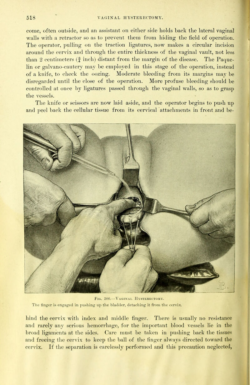come, often outside, and an assistant on either side holds back the lateral vaginal walls with a retractor so as to prevent them from hiding the field of operation. The operator, jmlling on the traction ligatures, now makes a circular incision around the cervix and through the entire thickness of the vaginal vault, not less than 2 centimeters (f inch) distant from the margin of the disease. The Paque- lin or galvano-cauterj may be employed in this stage of the operation, instead of a knife, to cheek the oozing. Moderate bleeding from its margins may be disregarded until the close of the operation. More profuse bleeding should be controlled at once by ligatures passed througb the vaginal walls, so as to grasp the vessels. The knife or scissors are now laid aside, and the operator begins to push up and peel back the cellular tissue from its cervical attachments in front and be- FiG. 300.—Vaoinal Hysterectomy. The iinger is engaged in pu.shing up the bhadtler, detaching it from the eervi.v. hind the cervix with index and middle finger. There is usually no resistance and rarely any serious hemorrhage, for the important blood vessels lie in the broad ligaments at the sides. Care must be taken in pushing back the tissues and freeing the cervix to keep the ball of the finger always directed toward the cervix. If the separation is carelessly performed and this precaution neglected,