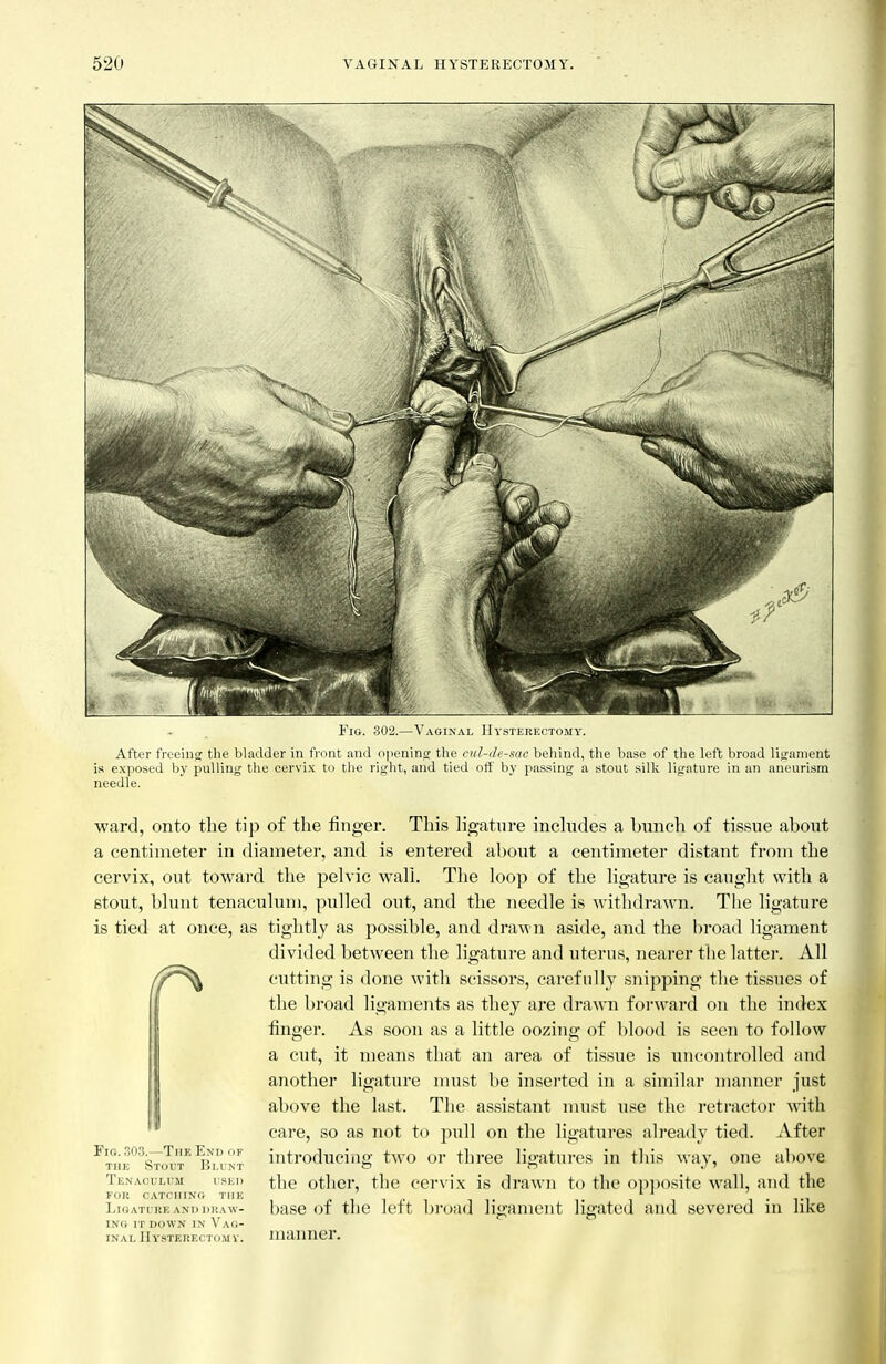 Vaginal IJysterkcto.my. After freeinsr the bladder in front and opening' the cul-de-sac behind, the base of the left broad ligament is exposed by pulling the cervix to th« right, and tied off by passing a stout silk ligature in an aneurism needle. ward, onto the tip of the finger. This ligature inchides a Imnch of tissue about a centimeter in diameter, and is entered about a centimeter distant from the cervix, out toward the pelvic wall. The loop of the ligature is caught with a stout, blunt tenaculum, pulled out, and the needle is withdrawn. The ligature is tied at once, as tightly as possible, and drawn aside, and the broad ligament divided between the ligature and uterus, nearer the latter. All cutting is done with scissors, carefully snipping the tissues of the broad ligaments as they are drawn foi-ward on the index finger. As soon as a little oozing of blood is seen to follow a cut, it means that an area of tissue is uncontrolled and another ligature nnist be insei'tcd in a similar manner just above the last. The assistant must use the retractor with care, so as not to pull on the ligatures already tied. After introduciiig two or thi'ee ligatures in this way, one above the other, the cervix is drawn to the op])osite wall, and the base of the left broad liojament ligated and severed in like Fifi. 303.—The End or THE Stout Blunt Tenaculum used roil catching the Ligature and draw- ing IT DOWN IN Vag- inal JI YSTEUECTO.M V. manner.
