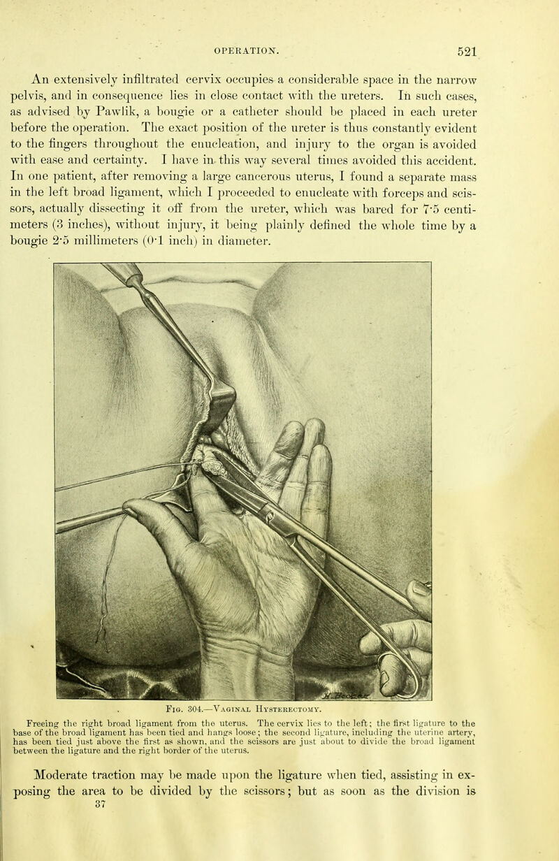 An extensively infiltrated cervix occupies a considerable space in the narrow pelvis, and in consequence lies in close contact with the ureters. In such cases, as advised by Pawlik, a bougie or a catheter should be placed in each ureter before the operation. The exact position of the ureter is thus constantly evident to the fingers throughout the enucleation, and injury to the organ is avoided with ease and certainty. I have in this w^ay several times avoided this accident. In one patient, after removing a large cancerous uterus, I found a separate mass in the left broad ligament, which I proceeded to enucleate with forceps and scis- sors, actually dissecting it oil from the ureter, which was bared for 7'5 centi- meters (3 inches), without injury, it being plainly defined the whole time by a bougie 25 millimeters (O'l inch) in diameter. Fig. 304.—Vaoinax Hystkrectomy. Freeing the right broad ligament from the uterus. The cervix lies to the left; the first ligature to the base of the broad ligament has been tied and hangs loose; the second li;^ature, including the uterine artery, has been tied just above the first as shown, and the scissors are just about to divide the broad ligament between the ligature and the right border of the uterus. Moderate traction may be made upon the ligature when tied, assisting in ex- posing the area to be divided by the scissors; but as soon as the division is 37