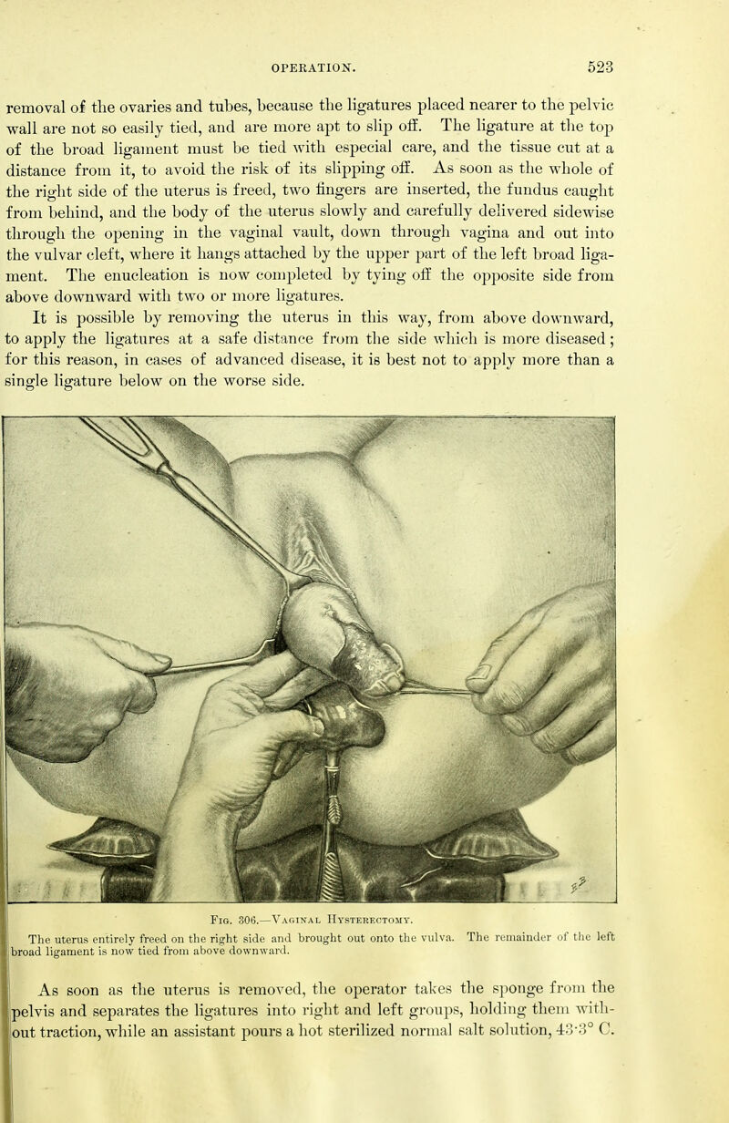 removal of the ovaries and tubes, because the hgatures placed nearer to the pelvic wall are not so easily tied, and are more apt to slip off. The ligature at the top of the broad ligament must be tied with especial care, and the tissue cut at a distance from it, to avoid the risk of its shpping off. As soon as the whole of the right side of the uterus is freed, two fingers are inserted, the fundus caught from behind, and the body of the uterus slowly and carefully delivered sidewise through the opening in the vaginal vault, down through vagina and out into the vulvar cleft, where it hangs attached by the upper part of the left broad liga- ment. The enucleation is now completed by tying off the opposite side from above downward with two or more ligatures. It is possible by removing the uterus in this way, from above downward, to apply the ligatures at a safe distance from the side which is more diseased; for this reason, in cases of advanced disease, it is best not to apply more than a single ligature below on the worse side. Fig. 306.—Vaginal PIysteeectomy. The uterus entirely freed on the right side and brought out onto the vulva. The remainder of the left broad ligament is now tied from above downward. As soon as the uterus is removed, the operator takes the sponge from the pelvis and separates the ligatures into right and left groups, holding them with- out traction, while an assistant pours a hot sterilized normal salt solution, 4:3-3° C.