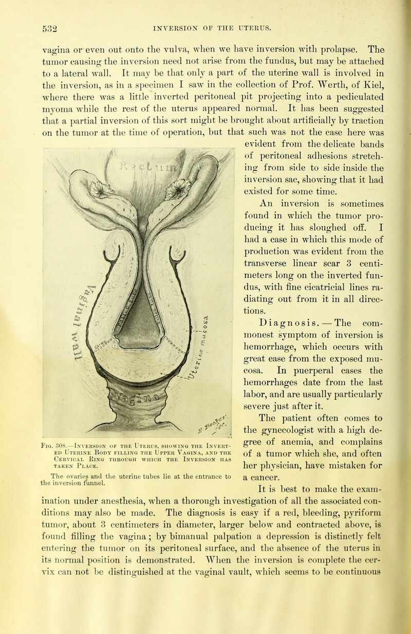 vagina or even out onto the vulva, when we have inversion with prolapse. The tumor causing the inversion need not arise from the fundus, but may be attached to a lateral wall. It may be that only a part of the uterine wall is involved in the inversion, as in a specimen I saw in the collection of Prof. Werth, of Kiel, where there was a little inverted peritoneal pit projecting into a pediculated myoma while the rest of the uterus appeared normal. It has been suggested that a partial inversion of this sort might be brought about artificially by traction on the tumor at the time of operation, but that such was not the case here was evident from the delicate bands of peritoneal adhesions stretch- ing from side to side inside the inversion sac, showing that it had existed for some time. An inversion is sometimes found in which the tumor pro- ducing it has sloughed oli. I had a case in which this mode of production was evident from the transverse linear scar 3 centi- meters long on the inverted fun- dus, with fine cicatricial lines ra- diating out from it in all direc- tions. Diagnosis. — The com- monest symptom of inversion is hemorrhage, which occurs with great ease from the exposed mu- cosa. In puerperal cases the hemorrhages date from the last labor, and are usually particularly severe just after it. The patient often comes to the gynecologist with a high de- gree of anemia, and complains of a tumor which she, and often her physician, have mistaken for a cancer. It is best to make the exam- ination under anesthesia, when a thorough investigation of all the associated con- ditions may also be made. The diagnosis is easy if a red, bleeding, pyriforni tumor, about 3 centimeters in diameter, larger below and contracted above, is found filling the vagina; by bimanual palpation a depression is distinctly felt entering the tumor on its peritoneal surface, and the absence of the uterus in its normal position is demonstrated. When the inversion is complete the cer- vix can not he distinguished at the vaginal vault, which seems to be continuous Fio. 308.—Inversion of the Uterus, showing the Invert- ed Uterine Boot filling tub Upper Vagina, and the Cervical Ring through which the Inversion has taken Place. Tlie ovaries and the uterine tubes lie at the entrance to the inversion funnel.
