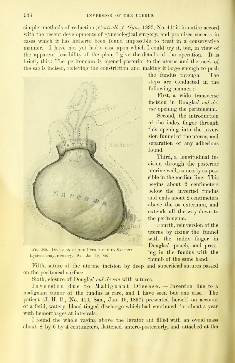 simpler methods of reduction {Centralb.f. Gyn., 1893, I^To. 41) is in entire accord with the recent developments of gynecological surgery, and promises success in cases which it has hitlierto been found impossible to treat in a conservative manner. I have not yet had a case upon which I could try it, but, in view of the a])parent feasibility of the plan, I give the details of the operation. It is briefly this: The peritoneum is opened posterior to the uterus and the neck of the sac is incised, relieving the constriction and making it large enough to push the fundus through. The steps are conducted in the following manner: First, a wide transverse incision in Douglas' cul-de- sac opening the peritoneum. Second, the introduction of the index finger through this opening into the inver- sion funnel of the utei'us, and separation of any adhesions found. Third, a longitudinal in- cision through the posterior uterine wall, as nearly as jjos- sible in the median line. This begins about 2 centimeters below the inverted fundus and ends about 2 centimeters above the os externum, and extends all the way down to the peritoneum. Fourth, rein version of the uterus by fixing the funnel with the index finger in Douglas' pouch, and press- ing in the fundus with the thumb of the same hand. Fifth, suture of the uterine incision by deep and superficial sutures passed on the peritoneal surface. Sixth, closure of Douglas' cul-de-sac with sutures. Inversion due to Malignant Disease. — Inversion due to a mahgnant tumor of the fundus is rare, and I have seen but one case. The patient (J. H. B., No. 410, San., Jan. 19, 1897) presented herself on account of a fetid, watery, blood-tinged discharge which had continued for about a year with hemorrhages at intervals. I found the whole vagina above the levator ani filled with an ovoid mass about 8 by 6 by 4 centimeters, flattened antero-posteriorly, and attached at the