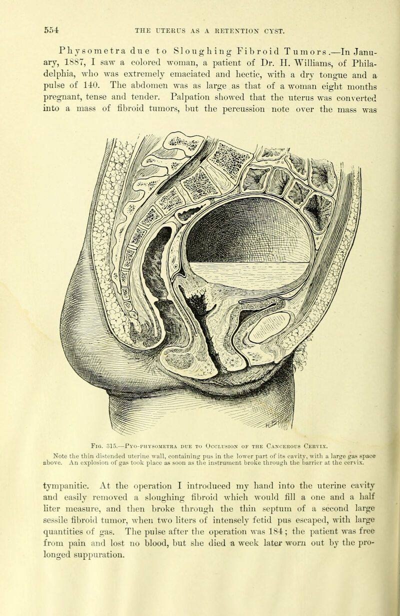 Phyeometra due to Sloughing Fibroid Tumors .—In Janu- ary, 1887, I saw a colored woman, a patient of Dr. H. Williams, of Phila- delphia, who was extremely emaciated and hectic, with a dry tongue and a pulse of 1-iO. The abdomen was as large as that of a woman eight months pregnant, tense and tender. Palpation showed that the uterus was cou\ erted into a mass of fibroid tumors, but the percussion note over the mass was Fig. 315.—Pyo-piiysometra due to Occlusion of the C.vncerous Cervix. Note the thin distended uterine wall, containincr pus in the lower part of its cavity, with a large aras space above. An explosion of gas took place as soon as the instrument broke through the barrier at the cervi.x. tympanitic. At the operation I introduced my hand into the uterine cavity and easily removed a sloughing liljroid which would fill a one and a half liter measure, and then broke through the thin septum of a second large sessile fibroid tumor, when two liters of intensely fetid pus escaped, with large quantities of gas. The pulse after the operation was 18-i; the patient was free from pain and lost no blood, but she died a week later worn out by the pro- longed suppuration.