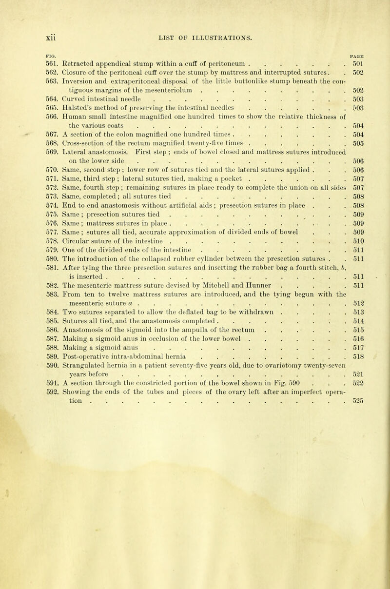 riG. PAGE 561. Retracted appendical stump within a cuff of peritoneum . 501 563. Closure of the peritoneal cuff over the stump by mattress and interrupted sutures. . 502 563. Inversion and extraperitoneal disposal of the little buttonlike stump beneath the con- tiguous margins of the mesenteriolum 502 564. Curved intestinal needle 503 565. Halsted's method of preserving the intestinal needles . 503 566. Human small intestine magnified one hundred times to show the relative thickness of the various coats 504 567. A section of the colon magnified one hundred times 504 568. Cross-section of the rectum magnified twenty-five times 505 569. Lateral anastomosis. First step ; ends of bowel closed and mattress sutures introduced on the lower side 506 570. Same, second step ; lower row of sutures tied and the lateral sutures applied . . . 506 571. Same, third step ; lateral sutures tied, making a pocket 507 572. Same, fourth step ; remaining sutures in place ready to complete the union on all sides 507 573. Same, completed ; all sutures tied 508 574. End to end anastomosis without artificial aids ; presection sutui'es in place . . . 508 575. Same ; presection sutures tied 509 576. Same ; mattress sutures in place ■ . . 509 577. Same ; sutures all tied, accurate approximation of divided ends of bowel . . . 509 578. Circular suture of the intestine 510 579. One of the divided ends of the intestine 511 580. The introduction of the collapsed rubber cylinder between the presection sutures . . 511 581. After tying the three presection sutures and inserting the rubber bag a fourth stitch, li, is inserted 511 582. The mesenteric mattress suture devised by Mitchell and Hunner 511 583. From ten to twelve mattress sutures are introduced, and the tying begun with the mesenteric suture a 512 584. Two sutures separated to allow the deflated bag to be withdrawn 513 585. Sutures all tied, and the anastomosis completed 514 586. Anastomosis of the sigmoid into the ampulla of the rectum . . . . . . 515 587. Making a sigmoid anus in occlusion of the lower bowel 516 588. Making a sigmoid anus 517 589. Post-operative intra-abdominal hernia 518 590. Strangulated hernia in a patient seventy-five years old, due to ovariotomy twenty-seven years before 521 591. A section through the constricted portion of the bowel shown in Fig. 590 . . . 522 592. Showing the ends of the tubes and pieces of the ovary left after an imperfect opera- tion 525