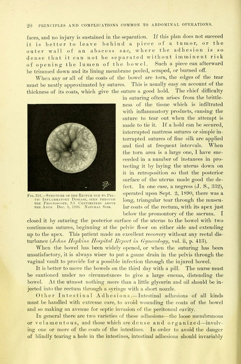 faces, and no injury is sustained in the separation. If this plan does not succeed it is better to leave behind a piece of a tumor, or the outer wall of an abscess sac, where the adhesion is so dense that it can not be separated without imminent risk of opening the lumen of t li e bowel. Such a piece can afterward be trimmed down and its Hning membrane peeled, scraped, or burned off. When any or all of the coats of the bowel are torn, the edges of the tear must be neatly approximated by sutures. This is usually easy on account of the thickness of its coats, which give the suture a good hold. The chief difficulty in suturing often arises from the brittle- ness of the tissue which is infiltrated with inflannnatory products, causing the suture to tear out when the attempt is made to tie it. If a hold can be secured, interrupted mattress sutures or simple in- teri'upted sutures of fine silk are applied and tied at frequent intervals. When the torn area is a large one, I have suc- ceeded in a number of instances in pro- tecting it by laying the uterus down on it in retroposition so that the posterior surface of the uterus made good the de- fect. In one case, a negress (J. S., 332), operated upon Sept. 2, 1890, there was a lonff, triangular tear throuo-h the muscu- lar coats of the rectum, with its apex just below the promontory of the sacrum. I closed it by suturing the posterior surface of the uterus to the bowel with two continuous sutures, beginning at the pelvic floor on either side and extending up to the apex. This patient made an excellent recovery without any rectal dis- turbance {Jo/nis II(>phin>< IIoKpital Report in Gynecology, vol. ii, p. 413). When the bowel has been widely opened, or when the suturing has been unsatisfactory, it is always wiser to put a gauze drain in the pelvis through the vaginal vault to provide for a possible infection through the injured bowel. It is better to move the bowels on the third day with a pill. The nurse must be cautioned under no circumstances to give a large enema, distending the bowel. At the utmost nothing more than a little glycerin and oil should be in- jected into the rectum through a syringe with a short nozzle. Other Intestinal Adhesions.—Intestinal adhesions of all kinds must be handled with extreme care, to avoid wounding the coats of the bowel and so making an avenue for septic invasion of the peritoneal cavity. In general there are two varieties of these adhesions—the loose membranous or V e 1 a m e n t o u s, and those which are dense and organize d—involv- ing one or more of the coats of the intestines. In order to avoid the danger of blindly tearing a hole in the intestines, intestinal adhesions should invariably Fig. 316.—Stricture of the Rectum ik e th I'ei.- vic Inflammatory Disease, seen through THE Proctoscope, 9.5 Centimeters above THE Anus. Dec. 8, 1896. Natural Size.