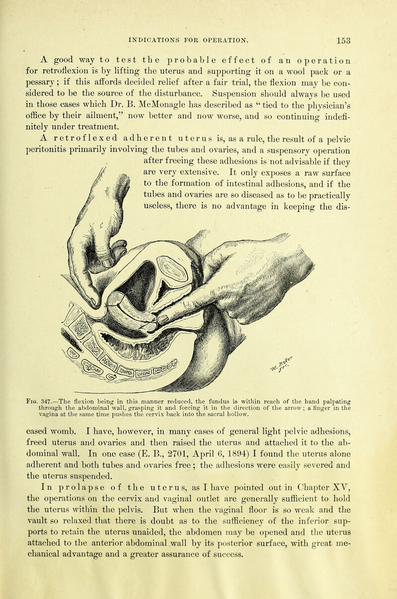 A good way to test the probable effect of an operation for retroflexion is by lifting the uterus and supporting it on a wool pack or a pessary; if this affords decided relief after a fair trial, the flexion may be con- sidered to be the source of the disturbance. Suspension should always be used in those cases which Dr. B. McMonagle has described as  tied to the physician's office by their ailment, now better and now worse, and so continuing indefi- nitely under treatment. A retroflexed adherent uterus is, as a rule, the result of a pelvic peritonitis primarily involving the tubes and ovaries, and a suspensory operation after freeing these adhesions is not advisable if they are very extensive. It only exposes a raw surface to the formation of intestinal adhesions, and if the tubes and ovaries are so diseased as to be practically useless, there is no advantage in keeping the dis- FiG. 34T.—The flexion being in this manner reduced, the fundus is within reach of the hand palpating through the abdominal wall, grasping it and forcing it in the direction of the arrow; a finger in the vagina at the same time pushes the cervix back into the sacral hollow. eased womb. I have, however, in many cases of general light pelvic adhesions, freed uterus and ovaries and then raised the uterus and attached it to the ab- dominal wall. In one case (E. B., 2701, April 6, 1894) I found the uterus alone adherent and both tubes and ovaries free ; the adhesions were easily severed and the uterus suspended. In prolapse of the uterus, as I have pointed out in Chapter XV, the operations on the cervix and vaginal oiitlet are generally sufiicient to hold the uterus within the pelvis. But when the vaginal floor is so weak and the vault so relaxed that there is doubt as to the sufficiency of the inferior sup- ports to retain the uterus unaided, the abdomen may be opened and the uterus attached to the anterior abdominal wall by its posterior surface, with great me- chanical advantage and a greater assurance of success.