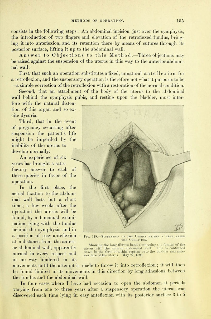 consists in the following steps: An abdominal incision just over the symphysis, the introduction of two fingers and elevation of the retroflexed fundus, bring- ing it into anteflexion, and its retention there by means of sutures through its posterior surface, lifting it up to the abdominal wall. Answer to Objections to this Method.—Three objections may be raised against the suspension of the uterus in this way to the anterior abdomi- nal wall: First, that such an operation substitutes a fixed, unnatural anteflexion for a retroflexion, and the suspensory operation is therefore not what it purports to be —a simple correction of the retroflexion with a restoration of the normal condition. Second, that an attachment of the body of the uterus to the abdominal wall behind the symphysis pubis, and resting upon the bladder, must inter- fere with the natural disten- tion of this organ and so ex- cite dysuria. Third, that in the event of pregnancy occurring after suspension the patient's life might be imperiled by the inability of the uterus to develop normally. An experience of six years has brought a satis- factory answer to each of these queries in favor of the operation. In the first place, the actual fixation to the abdom- inal wall lasts but a short time; a few weeks after the operation the uterus will be found, by a bimanual exami- nation, lying with the fundus behind the symphysis and in a position of easy anteflexion at a distance from the anteri- or abdominal wall, apparently normal in eveiy respect and in no way hindered in its movements until the attempt is made to throw it into retroflexion; it will then be found limited in its movements in this direction by long adhesions between the fundus and the abdominal wall. In four cases where I have had occasion to open the abdomen at periods varying from one to three years after a suspensory operation the uterus was discovered each time lying in easy anteflexion with its posterior surface 3 to 5 Fig. 349.—Suspension of the Ctekl:s within a Yeak after THE Operation. Showing tht) loufr fibrous band connecting the fundus of the uterus witii the anterior abdominal wall. This is continued dow n in the form of a thin septum over the bladder and ante- rior face of the uterus. May 27, 1896.