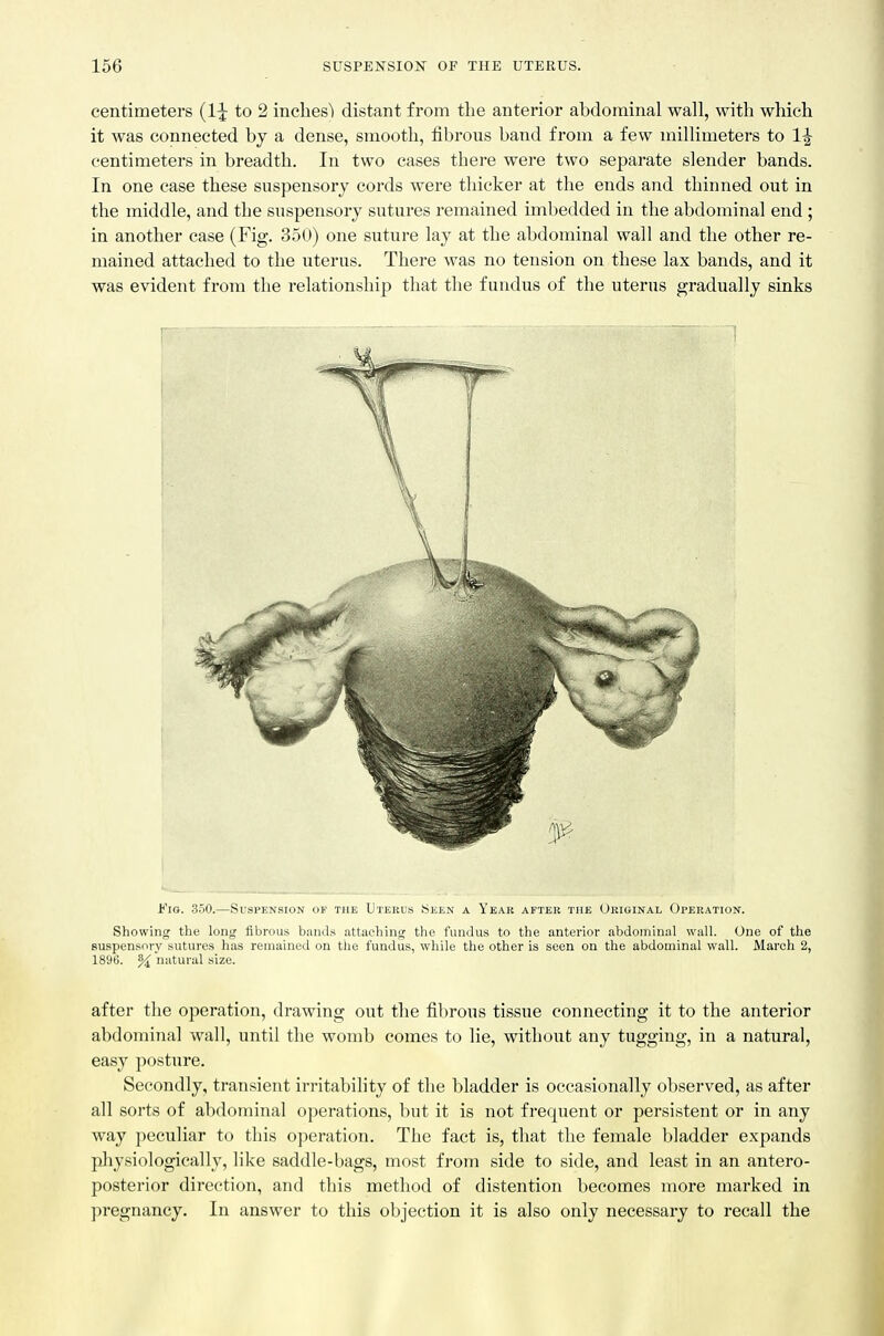 centimeters (IJ to 2 inches') distant from the anterior abdominal wall, with which it was connected by a dense, smooth, fibrous band from a few millimeters to 1^ centimeters in breadth. In two cases there were two separate slender bands. In one case these suspensory cords were thicker at the ends and thinned out in the middle, and the suspensory sutures remained imbedded in the abdominal end ; in another case (Fig. 350) one suture lay at the abdominal wall and the other re- mained attached to the uterus. There was no tension on these lax bands, and it was evident from the relationship that the fundus of the uterus gradually sinks Fig-. 350.—Suspension of the Uterus Seen a Year after the Original Operation. Showing the long fibrous bands attaching the fundus to the anterior abdominal wall. One of the suspensory sutures has remained on the fundus, while the other is seen on the abdominal wall. March 2, 1896. % natural size. after the operation, drawing out the fibrous tissue connecting it to the anterior abdominal wall, until the womb comes to lie, without any tugging, in a natural, easy posture. Secondly, transient irritabihty of the bladder is occasionally observed, as after all sorts of abdominal operations, but it is not frequent or persistent or in any way peculiar to this operation. The fact is, that the female bladder expands physiologically, like saddle-bags, most from side to side, and least in an antero- posterior direction, and this method of distention becomes more marked in pregnancy. In answer to this objection it is also only necessary to recall the