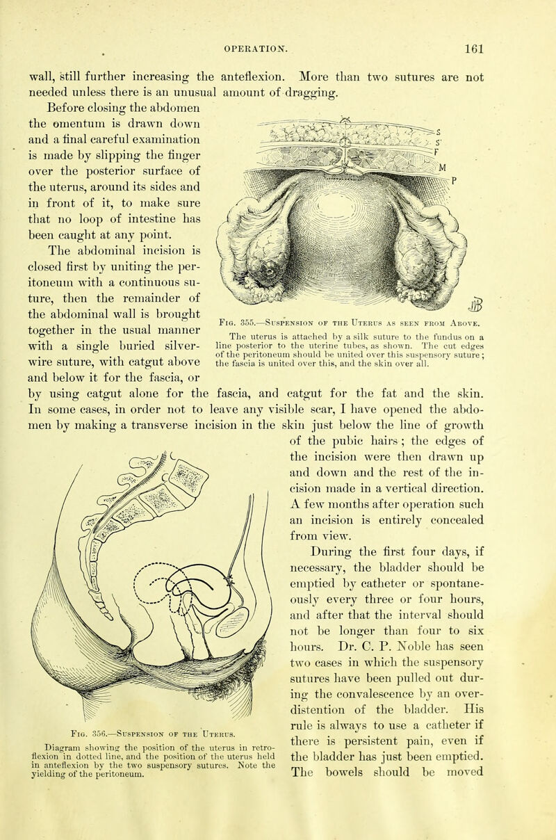 Fig. 355.—Suspension of the Uterus as seen from Above. The uterus is attached by a silk suture to the fundus on a line posterior to the uterine tubes, as shown. The cut edges of the peritoneum should be united over this suspensory suture ; the fascia is united over this, and the skin over all. wall, still further increasing the anteflexion. More than two sutures are not needed unless there is an unusual amount of dragging. Before closing the abdomen the omentum is drawn down and a final careful examination is made by slipping the finger over the posterior surface of the uterus, around its sides and in front of it, to make sure that no loop of intestine has been caught at any point. The abdominal incision is closed first by uniting the per- itoneum with a continuous su- ture, then the remainder of the abdominal wall is brought together in the usual manner with a single buried silver- wire suture, with catgut above and below it for the fascia, or by using catgut alone for the fascia, and catgut for the fat and the skin. In some cases, in order not to leave any visible scar, I have opened the abdo- men by making a transverse incision in the skin just below the line of growth of the pubic haii-s ; the edges of the incision were then drawn up and down and the rest of the in- cision made in a vertical direction. A few months after operation such an incision is entirely concealed from view. During the first four days, if necessary, the bladder should be emptied by catheter or spontane- ously every three or four hours, and after that the interval should not be longer than four to six hours. Dr. C. P. Noble has seen two cases in which the suspensory sutures have been pulled out dur- ing the convalescence by an over- distention of the bladder. His rule is always to use a catheter if Fig. 356.—Suspension of the Uterus. , . . . .» , . • • ^ , . there is persistent pain, even it Diagram showing the position of the uterus in retro- *■ _ -^ ' , flexion in dotted line, and the position of the uterus held the bladder haS just been emptied, in anteflexion by the two suspensory sutures. Note the - i i i i i j yielding of the peritoneum. ihe DOWels should be inoved