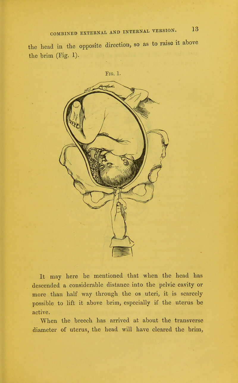 the head in the opposite direction, so as to raise it above the brim (Fig. 1). Tig. 1. It may here be mentioned that when the head has descended a considerable distance into the pelvic cavity or more than half way through the os uteris it is scarcely possible to lift it above brim, especially if the uterus be active. When the breech has arrived at about the transverse diameter of uterus, the head will have cleared the brim.