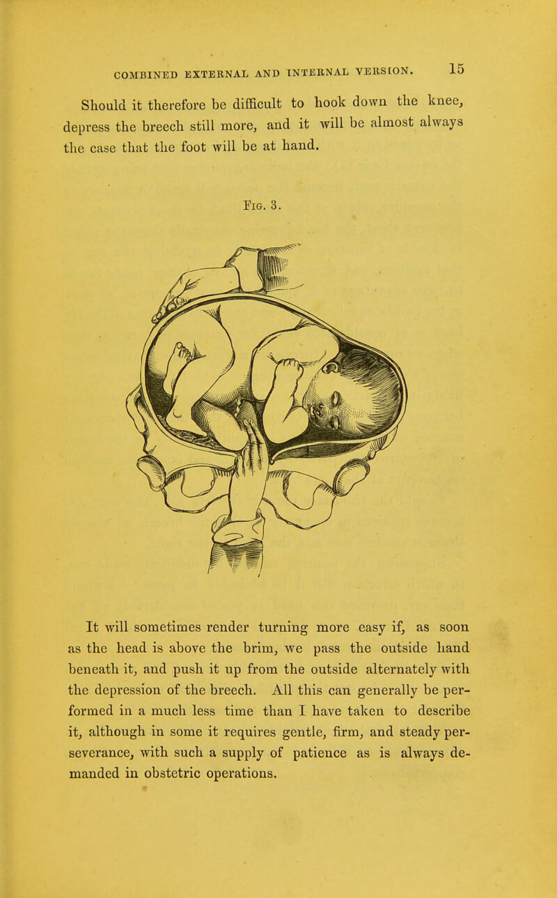 Should it therefore be difficult to hook down the knee, depress the breech still more, and it will be almost always the case that the foot will be at hand. Fig. 3. It will sometimes render turning more easy if, as soon as the head is above the brim, we pass the outside hand beneath it, and push it up from the outside alternately with the depression of the breech. All this can generally be per- formed in a much less time than I have taken to describe it, although in some it requires gentle, firm, and steady per- severance, with such a supply of patience as is always de- manded in obstetric operations.