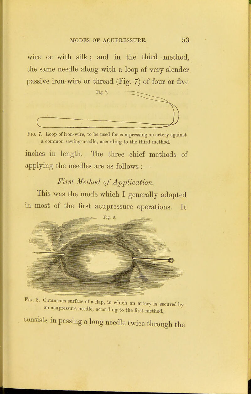 wire or with silk; and in the third method, the same needle along with a loop of very slender passive iron-wire or thread (Fig. 7) of four or five rig. 7. ( Fia. 7. Loop of iron-wire, to be used for compressing an artery against a commoa sewing-needle, according to the thu'd metliod. inches in length. The three chief methods of applying the needles are as follows :- - First Method of Application. This was the mode which I generally adopted in most of the first acupressure operations. It _^_r=t:^rr—- Fig- 8. Fra. 8. Cutaneous surface of a flap, in which an artery is secured by an acupressiu'e needle, according to the fii-st method. consists in passing a long needle twice through tho