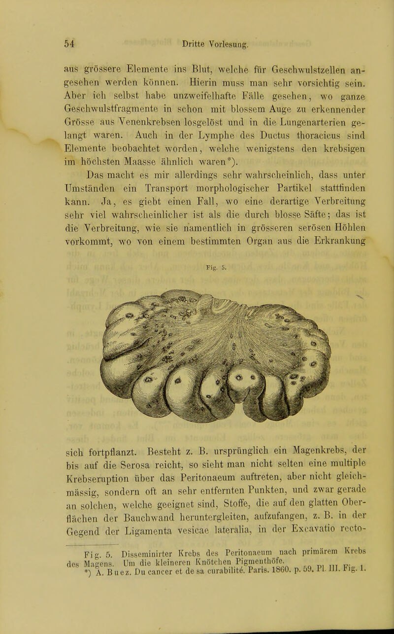 aus grössere Elemente ins Blut, welche für Geschwulstzellen an- gesehen w-erden können. Hierin muss man sehr vorsichtig sein. Aber ich selbst habe unzweifelhafte Fälle gesehen, wo ganze Geschwulstfragmente in schon mit blossem Auge zu erkennender Grösse aus Venenkrebsen losgelöst und in die Lungenarterien ge- langt w^aren. Auch in der Lymphe des Ductus thoracicus sind Elemente beobachtet worden, welche wenigstens den krebsigen im höchsten Maasse ähnlich waren*). Das macht es mir allerdings sehr wahrscheinlich, dass unter Umständen ein Transport morphologischer Partikel stattfinden kann. Ja, es giebt einen Fall, wo eine derartige Verbreitung sehr viel wahrscheinlicher ist als die durch blosse Säfte; das ist die Verbreitung, wie sie namentlich in grösseren serösen Höhlen vorkommt, wo von einem bestimmten Organ aus die Erkrankung Fig. 5. sich fortpflanzt. Besteht z. B. ursprünglich ein Magenkrebs, der bis auf die Serosa reicht, so sieht man nicht selten eine multiple Krebseruption über das Peritonaeum auftreten, aber nicht gleich- mässig, sondern oft an sehr entfernten Punkten, und zwar gerade an solchen, welche geeignet sind, Stoffe, die auf den glatten Ober- flächen der Bauchwand heruntergleiten, aufzufangen, z. B. in der Gegend der Ligamenta vesicae lateralia, in der Excavatio rccto- Fig. 5. Disseminirter Krebs des Peritonaeum nach primärem Krebs des Magens. Um die kleineren Knötelien Pigmenthofe. *) A. Buez. Du Cancer et desa curabilitö. Paris. 1860. p. 59. PI. III. Fig. 1.