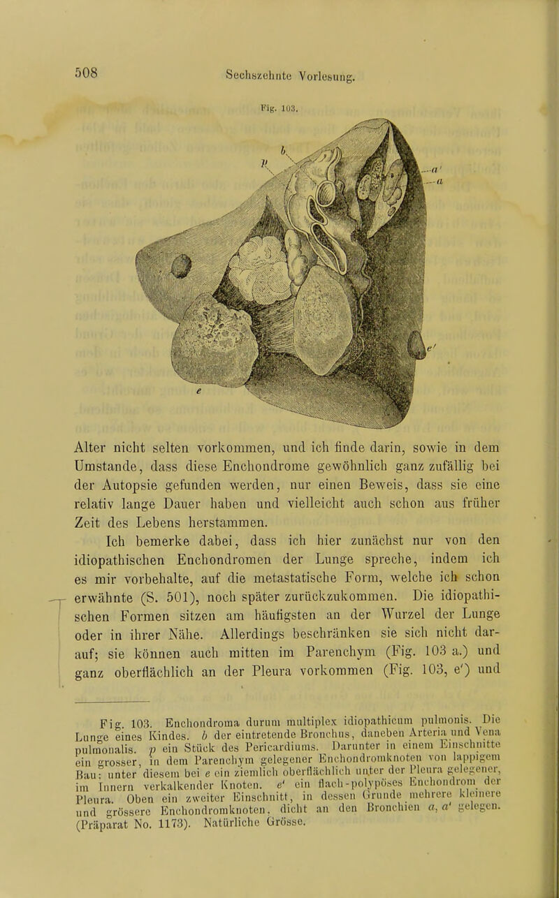 i'-ig. iu;i. Alter nicht selten vorkommen, und ich finde darin, sowie in dem Umstände, dass diese Enchondrome gewöhnlich ganz zufällig bei der Autopsie gefunden werden, nur einen Beweis, dass sie eine relativ lange Dauer haben und vielleicht auch schon aus früher Zeit des Lebens herstammen. Ich bemerke dabei, dass ich hier zunächst nur von den idiopathischen Enchondromen der Lunge spreche, indem ich es mir vorbehalte, auf die metastatische Form, welche ich schon erwähnte (S. 501), noch später zurückzukommen. Die idiopathi- schen Formen sitzen am häufigsten an der Wurzel der Lunge oder in ihrer Nähe. Allerdings beschränken sie sich nicht dar- auf; sie können auch mitten im Parenchym (Fig. 103 a.) und ganz oberflächlich an der Pleura vorkommen (Fig. 103, e') und Fig. 103. Enchondroma diiruni multiplex idiopathicum piilmonis. Die Lunn-e eines Kindes, b der eintretende Bront-hns, daneben Arteria und Vena pulrnonalis. V ei« Stück des Pericardiums. Darunter in eiuem Eiiuschnitto ein 'Grosser in dem Parenchym gelegener Encliondromknoten von lappigem Bau^ unter'diesem bei e ein ziemlich oberllächiich unter der Pleura gelegener, im Innern verkalkender Knoten, e' ein [lach-polypöses Enchondrom der Pleura Oben ein zweiter Einschnitt, in dessen (Iruude mehrere kleinere und grössere Enchondromknoten, dicht an den Bronchien a,a gelegen. (Präparat No. 1173). ISatüiiiche ürössc.