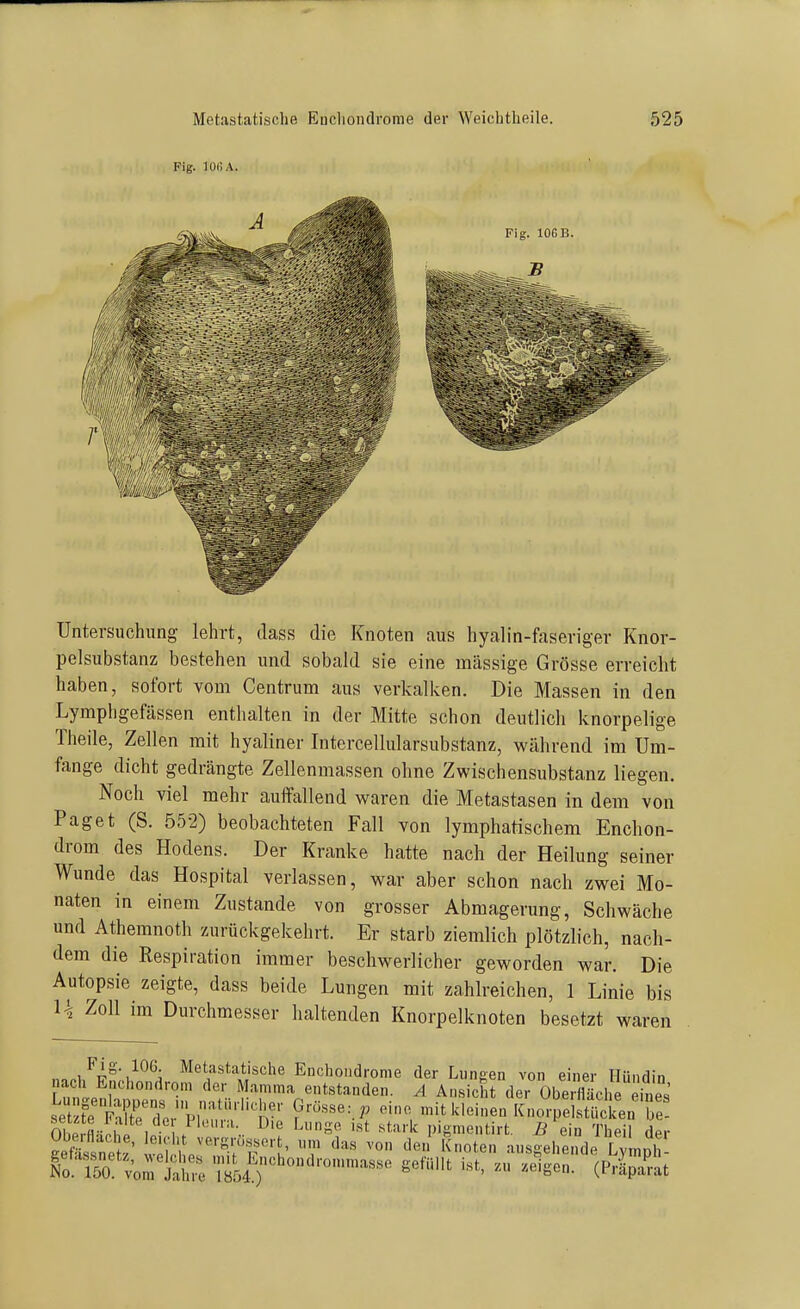 Untersuchung lehrt, dass die Knoten aus hyalin-faseriger Knor- pelsubstanz bestehen und sobald sie eine massige Grösse erreicht haben, sofort vom Centrum aus verkalken. Die Massen in den Lymphgefässen enthalten in der Mitte schon deutlicli knorpelige Theile, Zellen mit hyaliner Intercellularsubstanz, während im Um- fange dicht gedrängte Zellenmassen ohne Zwischensubstanz liegen. Noch viel mehr auffallend waren die Metastasen in dem von Paget (S. 552) beobachteten Fall von lymphatischem Enchon- drom des Hodens. Der Kranke hatte nach der Heilung seiner Wunde das Hospital verlassen, war aber schon nach zwei Mo- naten in einem Zustande von grosser Abmagerung, Schwäche und Athemnoth zurückgekehrt. Er starb ziemlich plötzlich, nach- dem die Respiration immer beschwerlicher geworden war. Die Autopsie zeigte, dass beide Lungen mit zahlreichen, 1 Linie bis U Zoll im Durchmesser haltenden Knorpelknoten besetzt waren Fig. 106. Metastatische Enchoiidronie der Lungen von einer Hiiiiflin nach Enchondrom der Mamma entstanden. A AnsicfrderObe fläci e eines set feÄ'e'Tcrp;'''''''1r' '-^ kleinen KnorpelstSen re! Se fläci^e leiH,. vi ''^ '^''''^ pigmentirt. i? ein Theil der Ste ISl p ^- pi' '^^'^ '^'°*'^» ausgehende Lymph- Ä'torlahre Ti^ö^^;'^'^'''— ^^'^ -ig«- (Pripa^at