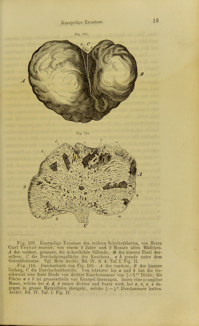Fig. 109. u Fig. 109. Knorpelige Exostose des rechten Schulterblattes, von Herrn Carl Textor resecirt, von einem 2 Jahre und 2 Monate alten Mädchen. A der vordere, grössere, die Achselhöhle füllende, ß der hintere Theil der- selben; C die Durchsägungsfläche des Knochens, a b gerade unter dem Gelenkfortsatze. Vgl. Mein Archiv, Bd. IV. S. 4. Tat. I. Fig. II. Fig. 110. Durchschnitt von Fig. 109. A der vordere, B der hintere Umfang, C die Durchschnittsstelie. Von letzterer bis a und h hat die Ge- schwulst eine feste Rinde von dichter Knochenmasse von Dicke; die Fläche a c 6 ist grossentheils von Knorpel überzogen. Innen eine spongiöse Masse, welche bei d, d, d immer dichter und fester wird, bei e, e, e, e da- gegen in grosse Markhöhlen übergeht, welche k — k Durchmesser hatten. Archiv, ßd. IV. Taf. I. Fig. IV.