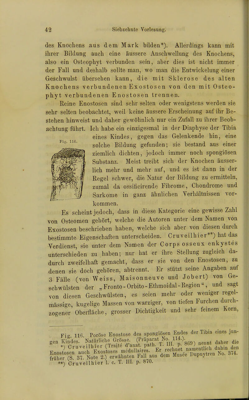 Fi.'. 116. des Knochens aus dem Mark bilden*). Allerdings kann mit ihrer Bildung auch eine äussere Anschwellung des Knochens, also ein Osteophyt verbunden sein, aber dies ist nicht immer der Fall und deshalb sollte man, wo man die Entwickelung einer Geschwulst übersehen kann, die mit Sklerose des alten Knochens verbundenen Ex osto sen von den mit Osteo- phyt verbundenen Enostosen trennen. Reine Enostosen sind sehr selten oder wenigstens werden sie sehr selten beobachtet, weil keine äussere Erscheinung auf ihr Be- stehen hinweist und daher gewöhnlich nur ein Zufall zu ihrer Beob- achtung führt. Ich habe ein einzigesmal in der Diaphyse der Tibia eines Kindes, gegen das Gelenkende hin, eine solche Bildung gefunden; sie bestand aus einer ziemlich dichten, jedoch immer noch spongiösen Substanz. Meist treibt sich der Knochen äusser- lich mehr und mehr auf, und es ist dann in der Regel schwer, die Natur der Bildung zu ermitteln, zumal da ossiticirende Fibrome, Chondrome und Sarkome in ganz ähnlichen Verhältnissen vor- kommen. Es scheint jedoch, dass in diese Kategorie eine gewisse Zahl von Osteomen gehört, welche die Autoren unter dem Namen von Exostosen beschrieben haben, welche sich aber von diesen durch bestimmte Eigenschaften unterscheiden. Oruveilhier**) hat das Verdienst, sie unter dem Namen der Corps osseux enkystes unterschieden zu haben; nur hat er ihre Stellung zugleich da- durch zweifelhaft gemacht, dass er sie von den Enostosen, zu denen sie doch gehören, abtrennt. Er stützt seine Angaben auf 3 Fälle (von Weiss, Maisonneuve und Jobert) von Ge- schwülsten der „Fronto-Orbito-Ethmoidal-Region«, und sagt von diesen Geschwülsten, es seien mehr oder weniger regel- mässige, kugelige Massen von warziger, von tiefen Furchen durch- zogener Oberfläche, grosser Dichtigkeit und sehr feinem Korn, Fig 116 Poröse Enostose des spongiösen Endes der Tibia eines jun- gen Kindes. Natürliche Grösse (fr^P=Jj;=^V^il n 869^ nennt daher die Ornveilhier (Traite d'anat. path. 1. Hl- P- obJ) nenno u.ui > **) Oruveilhier I. c. T. III. p. 870.
