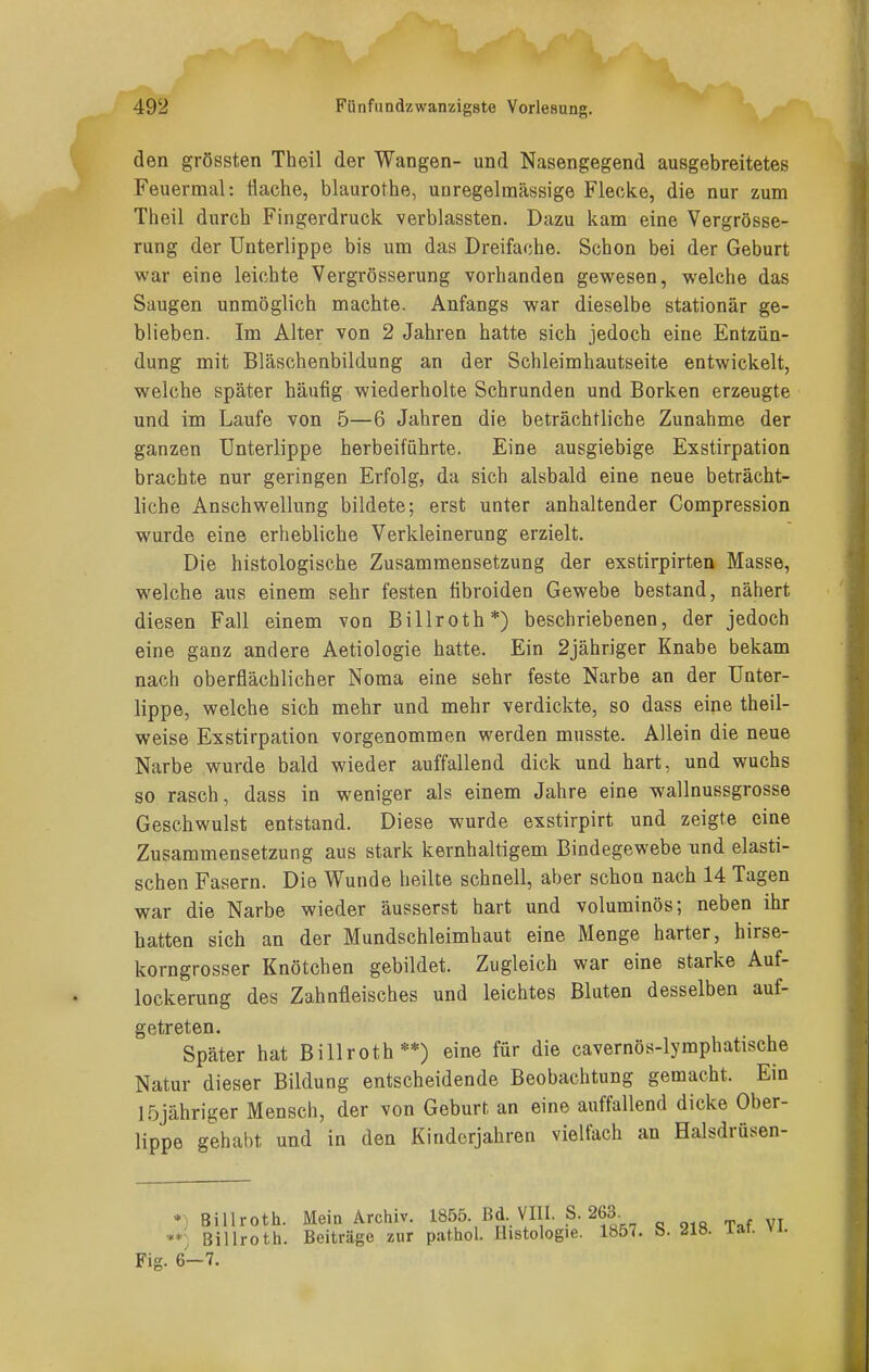 den grössten Theil der Wangen- und Nasengegend ausgebreitetes Feuermal: Üache, blaurothe, uaregelmässige Flecke, die nur zum Theil durch Fingerdruck verblassten. Dazu kam eine Vergrösse- rung der Unterlippe bis um das Dreifache. Schon bei der Geburt war eine leichte Vergrösserung vorhanden gewesen, welche das Saugen unmöglich machte. Anfangs war dieselbe stationär ge- blieben. Im Alter von 2 Jahren hatte sich jedoch eine Entzün- dung mit Bläschenbildung an der Schleimhautseite entwickelt, welche später häufig wiederholte Schrunden und Borken erzeugte und im Laufe von 5—6 Jahren die beträchtliche Zunahme der ganzen Unterlippe herbeiführte. Eine ausgiebige Exstirpation brachte nur geringen Erfolg, da sich alsbald eine neue beträcht- liche Anschwellung bildete; erst unter anhaltender Compression wurde eine erhebliche Verkleinerung erzielt. Die histologische Zusammensetzung der exstirpirten Masse, welche aus einem sehr festen tibroiden Gewebe bestand, nähert diesen Fall einem von Billroth*) beschriebenen, der jedoch eine ganz andere Aetiologie hatte. Ein 2jähriger Knabe bekam nach oberflächlicher Noma eine sehr feste Narbe an der Unter- lippe, welche sich mehr und mehr verdickte, so dass eine theil- weise Exstirpation vorgenommen werden musste. Allein die neue Narbe wurde bald wieder auffallend dick und hart, und wuchs so rasch, dass in weniger als einem Jahre eine wallnussgrosse Geschwulst entstand. Diese wurde exstirpirt und zeigte eine Zusammensetzung aus stark kernhaltigem Bindegewebe und elasti- schen Fasern. Die Wunde heilte schnell, aber schon nach 14 Tagen war die Narbe wieder äusserst hart und voluminös; neben ihr hatten sich an der Mundschleimhaut eine Menge harter, hirse- korngrosser Knötchen gebildet. Zugleich war eine starke Auf- lockerung des Zahnfleisches und leichtes Bluten desselben auf- getreten. Später hat Billroth**) eine für die cavernös-lymphatische Natur dieser Bildung entscheidende Beobachtung gemacht. Ein löjähriger Mensch, der von Geburt an eine auffallend dicke Ober- lippe gehabt und in den Kinderjahren vielfach an Halsdrüsen- •) Billrotli. Mein Archiv. 1855. Bd VIII. S. 263. **, Billroth. Beiträge zur pathol. Histologie. 1857. b. Jlö. lai. vi. Fig. 6-7.