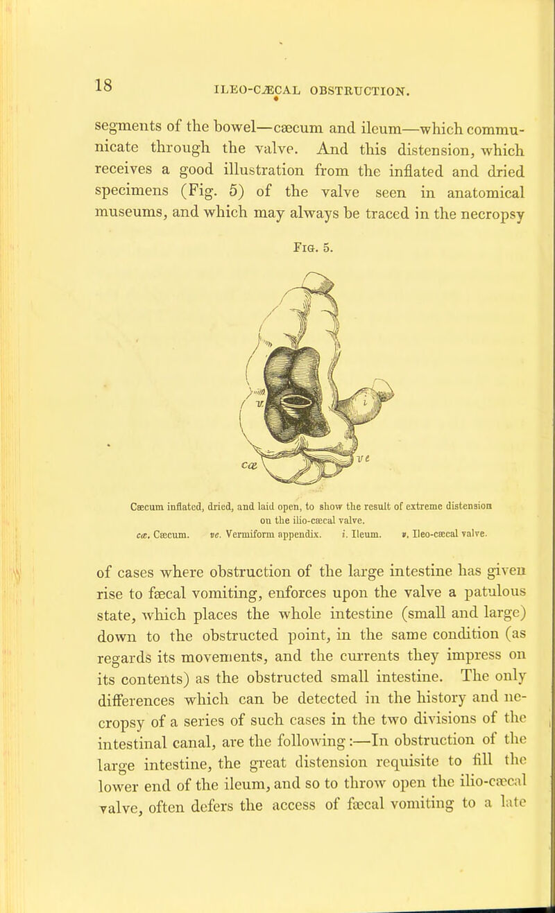 segments of the bowel—csecum and ileum—which commu- nicate through the valve. And this distension, which receives a good illustration from the inflated and dried specimens (Fig. 5) of the valve seen in anatomical museums, and which may always be traced in the necropsy Fig. 5. Caecum inflated, dried, and laid open, to aliow the result of extreme distension on tlie ilio-csecal valve. cm. Caecum. ve. Vermiform appendix. i. Ileum. ». Ileo-csecal valve. of cases where obstruction of the large intestine has given rise to fsecal vomiting, enforces upon the valve a patulous state, which places the whole intestine (small and large) down to the obstructed point, in the same condition (as regards its movements, and the currents they impress on its contents) as the obstructed small intestine. The only differences which can be detected in the history and ne- cropsy of a series of such cases in the two divisions of the intestinal canal, are the foUoAving:—In obstruction of the large intestine, the gi'eat distension requisite to fill the lower end of the ileum, and so to throw open the ilio-ca?cal valve, often defers the access of faecal vomiting to a late