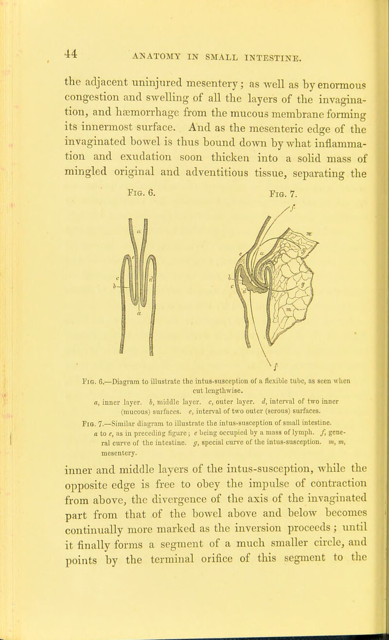 ANATOMY IN SMALL INTESTINE. the adjacent uninjured mesentery; as well as by enormous congestion and swelling of all the layers of the invagina- tion, and hfemorrhage from the mucous membrane forming its innermost surface. And as the mesenteric edge of the invaginated bowel is thus bound down by what inflamma- tion and exudation soon thicken into a soHd mass of mingled original and adventitious tissue, separating the Fie. 6. Fig. 7. Fig. G.—Diagram to illustrate the intus-susceptiou of a flexible tube, as seen when cut lengthwise. a, inner layer, h, niitUIe layer, c, outer layer, d, interval of two inner (raucous) surfaces, e, iuten-al of two outer (serous) surfaces. Fio. 7.—Similar diagram to illustrate the intus-susception of small intestine. a to e, as iu preceding figure; e being occupied hy a mass of lymph. /, gene- ral curve of the intestine, g, special curve of the intus-susception. w, m, mesentery. inner and middle layers of the intus-susception, while the opposite edge is free to obey the impulse of contraction from above, the divergence of the axis of the invaginated part from that of the bowel above and below becomes continually more marked as the inversion proceeds; until it finally forms a segment of a much smaller circle, and points by the terminal orifice of this segment to the