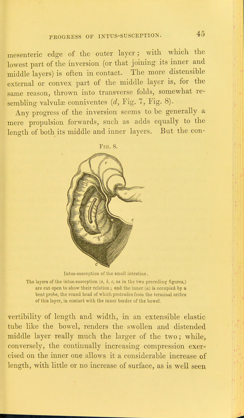 mesenteric edge of the oiiter layer; with which the lowest part of the inversion (or that joining its inner and middle layers) is often in contact. The more distensible external or convex part of the middle layer is, for the same reason, thrown into transverse folds, somewhat re- sembling valvulaj conniventes {d, Fig. 7, Fig. 8). Any progress of the inversion seems to be generally a mere propulsion forwards, such as adds equally to the length of both its middle and inner layers. But the con- FiG. 8. Intus-susceptiou of the small intestine. The layers of the intus-susceptiou (a, 5, c, as in the two preceding figxires,) are cut open to sliow their relation ; and tlie inner (a) is occupied by a bent probe, the round head of wliicb protrudes from tlie termiual orifice of this layer, in contact \vitli the inner border of the bowel. vertibility of length and width, in an extensible elastic tube hke the bowel, renders the swollen and distended middle layer really much the larger of the two; while, conversely, the continually increasing compression exer- cised on the inner one allows it a considerable increase of length, with little or no increase of surface, as is well seen