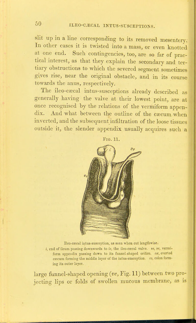 ILEO-C^CAL INTUS-SUSCEPTIONS. slit in a line corresponding to its removed mesenterj-. In other cases it is twisted into a mass, or even knotted at one end. Such contingencies, too, are so far of prac- tical interest, as that they explain the secondary and ter- tiary obstructions to which the severed segment sometimes gives rise, near the original obstacle, and in its course towards the anus, resjoectively. The ileo-csecal intus-susceptions already described as generally having the valve at their lowest point, are at once recognised by the relations of the vermiform appen- dix. And what between the outline of the csecum when inverted, and the subsequent infiltration of the loose tissues outside it, the slender appendix usually acquires such a Fig. 11. Ileo-c8ecal intus-snsception, aa seen wlien cut lengthwise. i, end of ileum passing downwards to ic, the ileo-Cfccal valve, ve, te, vermi- form appendix passing down to its funncl-sliaped orifice. c<r, everted cmcum forming the middle layer of the iutus-susception. co, colon form- ing its outer layer. large funnel-shaped opening (ve, Fig. 11) between two pro- jecting lips or folds of swollen mucous membrane, as is