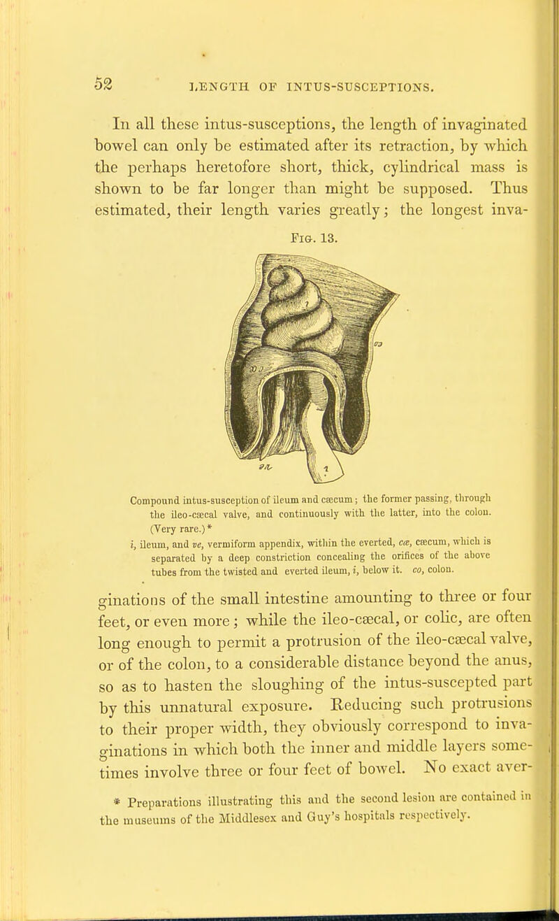 In all these intus-susceptions, the length of invaginated bowel can only be estimated after its retraction, by which the perhaps heretofore short, thick, cylindrical mass is shown to be far longer than might be supposed. Thus estimated, their length varies greatly; the longest inva- FiG. 13. Compound intus-susception of ileum and caecum; the former passing, tlirougli tlie Ueo-csccal valve, and continuously with the latter, into the colon. (Very rare.) * 1, ileum, and ve, vermiform appendix, within the everted, <;«, ciECum, which is separated by a deep constriction concealing the orifices of the above tubes from the twisted and everted ileum, i, below it. co, colon. ginations of the small intestine amounting to thi-ee or four feet, or even more; while the ileo-caecal, or colic, are often long enough to permit a protrusion of the ileo-caecal valve, or of the colon, to a considerable distance beyond the anus, so as to hasten the sloughing of the intus-suscepted part by this unnatural exposure. Reducing such protrusions to their proper width, they obviously correspond to inva- ginations in which both the inner and middle layers some- times involve three or four feet of bowel. No exact aver- » Preparations illustrating this and the second lesion are containcil in the museums of the Middlesex and Guy's hospitals respectively.