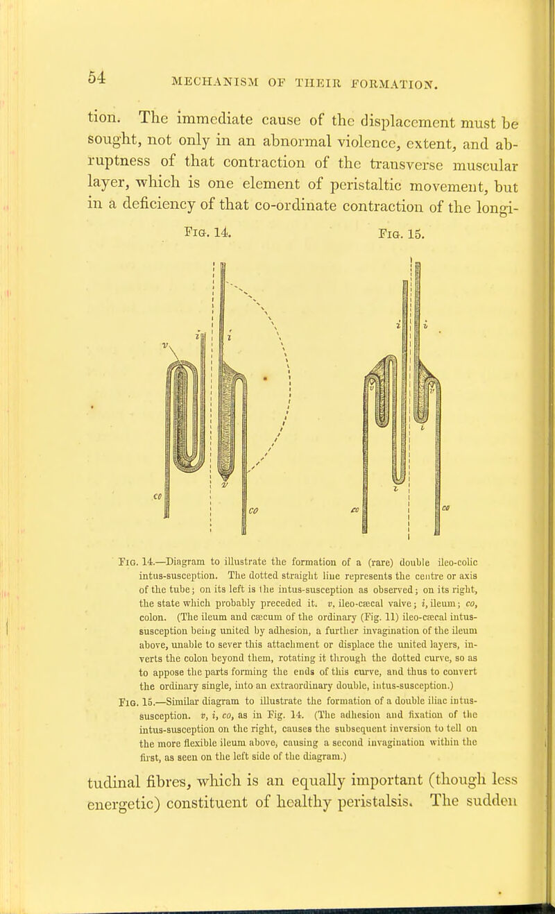 MECHANISM OF TIIKIR FORMATION. tion. The immediate cause of the displacement must he sought, not only in an abnormal violence, extent, and ah- ruptness of that contraction of the transverse muscular layer, which is one element of peristaltic movement, but in a deficiency of that co-ordinate contraction of the longi- I'lG. 14. Fig. 15. Fig. 14.—Diagram to illustrate the formation of a (rare) double Ueo-colic intus-susception. The dotted straight liue represents the centi'e or a.\is of the tube; on its left is the intus-susception as observed; on its right, the state which probably preceded it. », ileo-ciecal valve; i, ileum; co, colon. (The ileum and caecum of the ordinary (Fig. 11) ileo-caecal intus- susception being united by adhesion, a further invagination of the ileum above, unable to sever this attachment or displace the united layers, in- verts the colon beyond them, rotating it through the dotted curve, so as to appose the parts fonning the ends of this curve, and thus to convert the ordinary single, into an extraordinary double, intus-susception.) Fig. 15.—Similar diagram to illustrate the formation of a double iliac intus- susception. V, i, CO, as in Fig. 14. (The adhesion and fixation of the intus-susception on the right, causes the subsequent inversion to tell on the more ile-xible ileum above, causing a second invagination within the fiist, as seen on the left side of the diagram.) tudinal fibres, which is an equally important (though less energetic) constituent of healthy peristalsis. The sudden