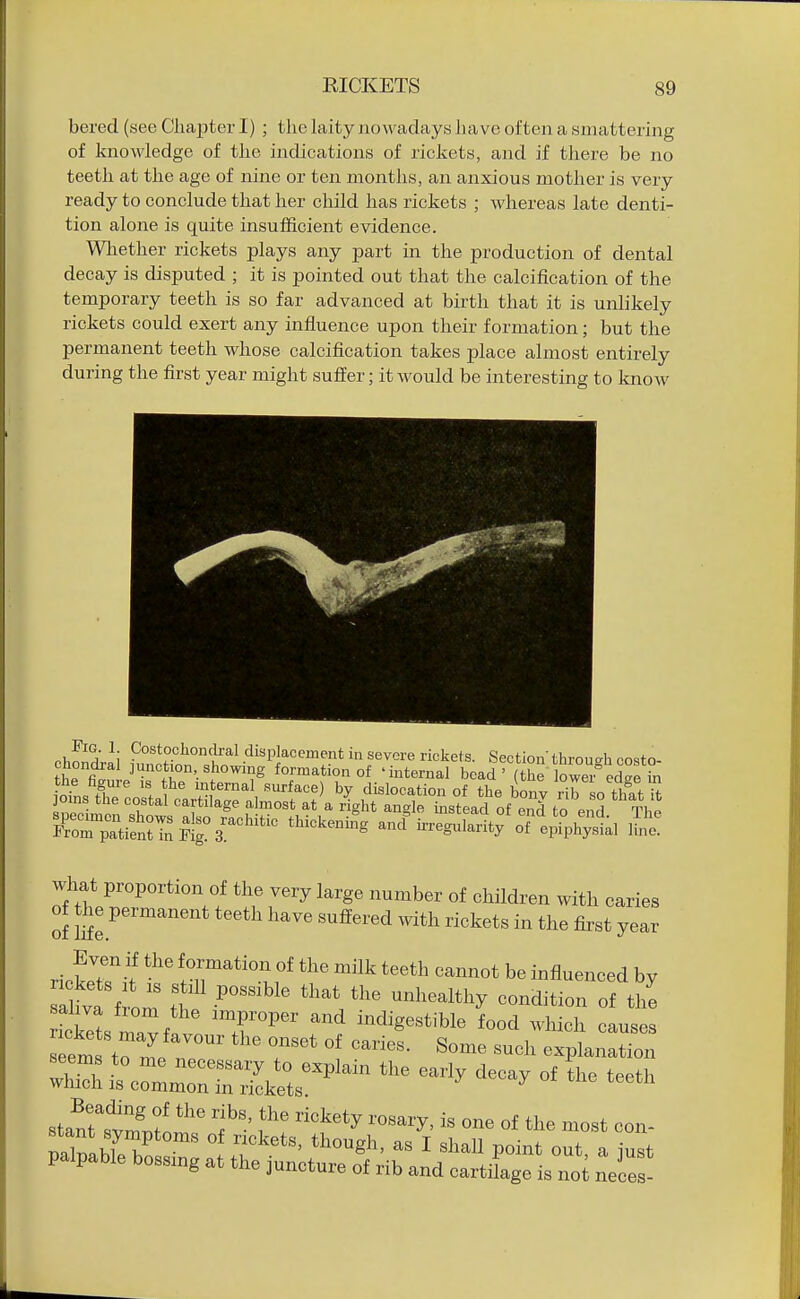 bered (see Cliaj)ter I) ; the laity nowadays have often a smattering of knowledge of the indications of rickets, and if there be no teeth at the age of nine or ten niontlis, an anxious mother is very ready to conclude that her child has rickets ; whereas late denti- tion alone is quite insufficient evidence. Wliether rickets plays any part in the production of dental decay is disputed ; it is pointed out that the calcification of the temporary teeth is so far advanced at birth that it is unhkely rickets could exert any influence upon their formation; but the permanent teeth whose calcification takes place almost entirely during the first year might suffer; it would be interesting to know what proportion of the very large number of children with caries of the permanent teeth have suffered with rickets in the first year rickeTit l^'^^'^^lf teeth cannot be influenced by rickets mavflvn 'T^ f^ indigestible food which causes em trr^eZ ■ ° ^^^^ explanation seems to me necessary to explain the early decay of the teeth which IS common in rickets ^ stanrstlto'^ f'^^'^ ^^^^'y' ^« °f ^ost con-