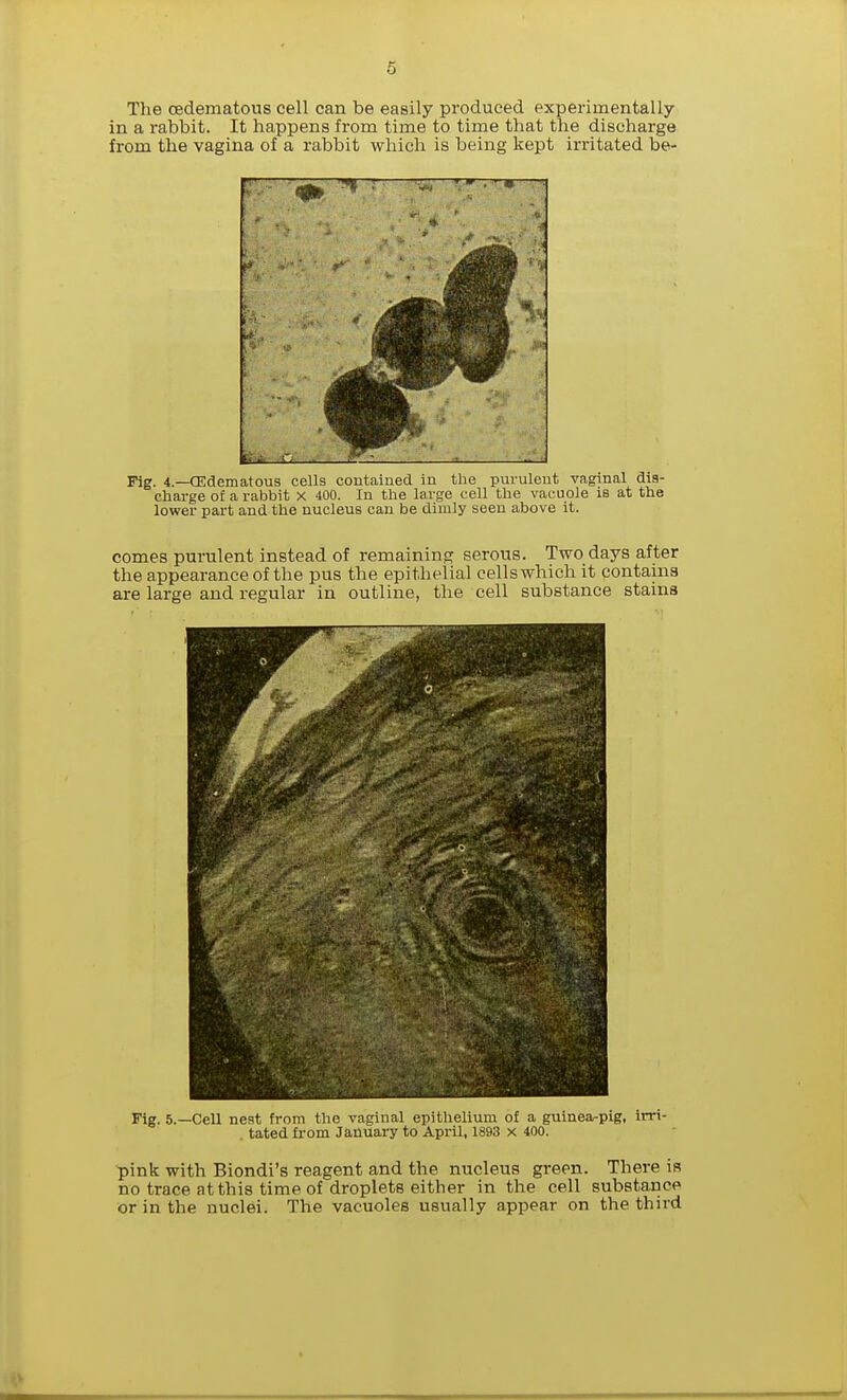 The cedematous cell can be easily produced experimentally in a rabbit. It happens from time to time that the discharge from the vagina of a rabbit which is being kept irritated be- Fig. 4.—CEdematous cells contained in the purulent vaginal dis- charge of a rabbit x 400. In the large cell the vacuole is at the lower part and the nucleus can be dimly seen above it. comes purulent instead of remaining serous. Two days after the appearance of the pus the epithelial cellswhich it contains are large and regular in outline, the cell substance stains Fig. 5.—Cell nest from the vaginal epithelium of a guinea-pig, irri- tated from January to April, 1893 x 400. ■pink with Biondi's reagent and the nucleus green. There is no trace at this time of droplets either in the cell substance or in the nuclei. The vacuoles usually appear on the third