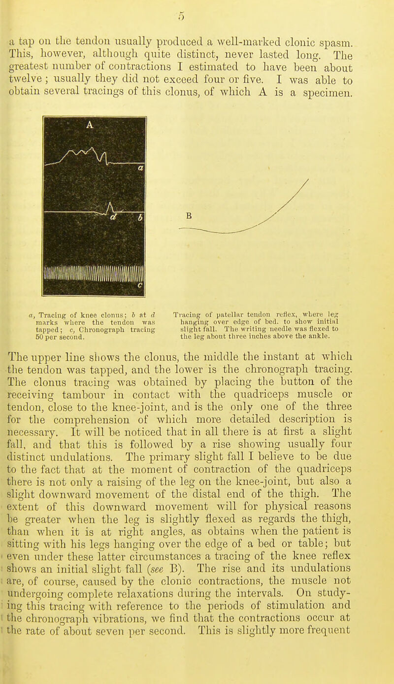 6 a tap on the tendon usually produced a well-marked clonic spasm. This, however, although quite distinct, never lasted long. The greatest number of contractions I estimated to have been about twelve ; usually they did not exceed four or five. I was able to obtain several tracings of this clonus, of which A is a specimen. a, Tracing of knee clonus; b at d Ti-acing of patellar tendon reflex, where leg marks where the tendon was hanging over edge of bed. to show initial tapped ; c, Chronograph tracing slight fall. The writing needle was flexed to 50 per second. the leg about three inches above the ankle. The upper line shows the clonus, the middle the instant at which the tendon was tapped, and the lower is the chronograph tracing. The clonus tracing was obtained by placing tlie button of the receiving tambour in contact with the quadriceps muscle or tendon, close to the knee-joint, and is the only one of the three for the comprehension of which more detailed description is necessary. It will be noticed that in all there is at first a slight fall, and that this is followed by a rise showing usually four distinct undulations. The primary slight fall I believe to be due to the fact that at the moment of contraction of the quadriceps tliere is not only a raising of the leg on the knee-joint, but also a slight downward movement of the distal end of the thigh. The extent of this downward movement will for physical reasons be greater when the leg is slightly flexed as regards the thigh, than when it is at right angles, as obtains when the jDatient is sitting with his legs hanging over the edge of a bed or table; but ' even under these latter circumstances a tracing of the knee reflex shows an initial slight fall (see B). The rise and its undulations ■ are, of course, caused by the clonic contractions, the muscle not ■ undergoing complete relaxations during the intervals. On study- ' ing this tracing with reference to the periods of stimulation and ' the chronograph vibrations, we find that the contractions occur at the rate of about seven per second. This is slightly more frequent