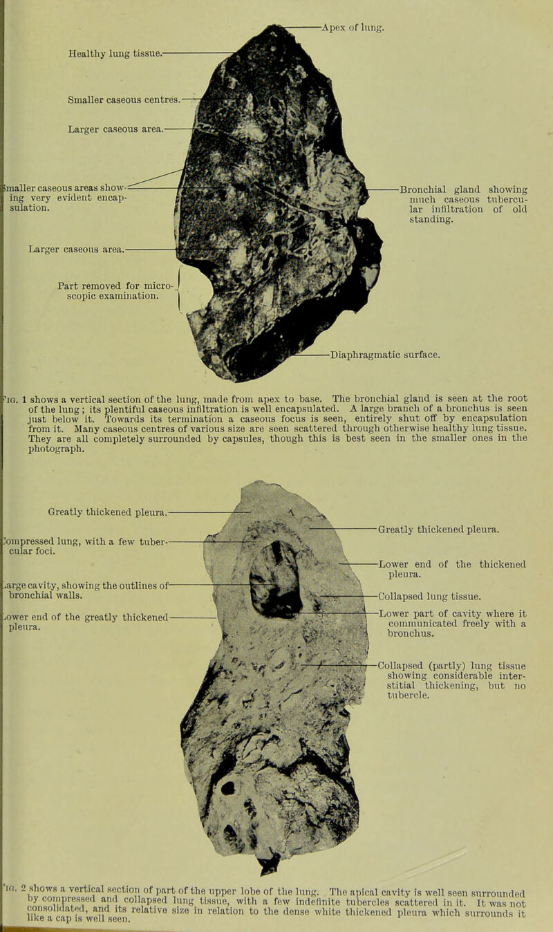 iG. 1 shows a vertical section of the lung, made from apex to base. The bronchial gland is seen at the root of the lung ; its plentiful caseous infiltration is well encapsulated. A large branch of a bronchus is seen just below it. Towards its termination a caseous focus is seen, entirely shut off by encapsulation from it. Many caseous centres of various size are seen scattered through otherwise healthy lung tissue. They are all completely surrounded by capsules, though this is best seen in the smaller ones in the photograph. Greatly thickened pleura.- 'ompressed lung, with a few tuber- cular foci. arge cavity, showing the outlines of bronchial walls. ower end of the greatly thickened pleura. Greatly thickened pleura. ■Lower end of the thickened pleura. ■Collapsed lung tissue. ■Lower part of cavity where it communicated freely with a I bronchus. CoUapsed (partly) lung tissue showing considerable inter- stitial thickening, but no tubercle. in. 2 shows a vertical section of part of the upper lobe of the lung. The apical cavity is well seen surrounded by coiiipressed and collapsed lung tissue, with a few indednite tubercles scattered in it. It was not consolKlateU, and its relative size in relation to the dense white thickened pleura wliich surrounds it