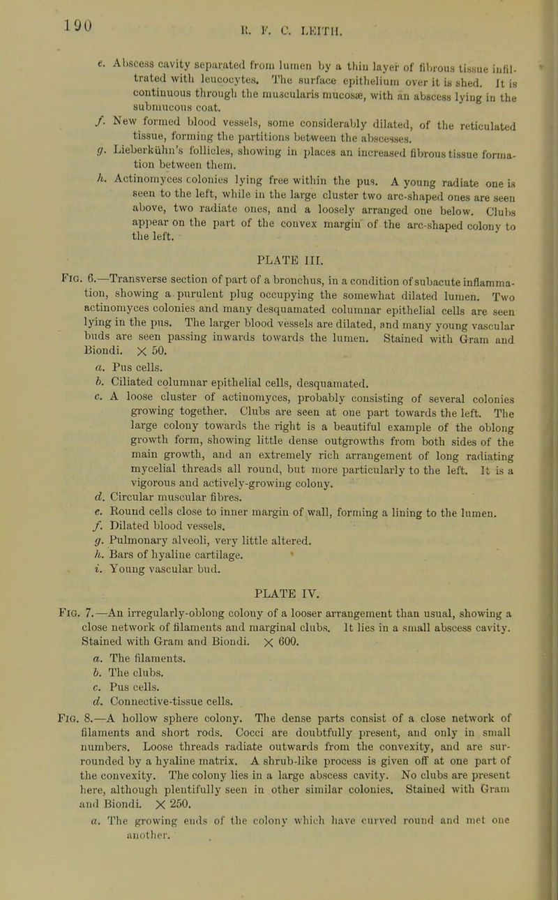 H. V. C. LKITIl. e. Abscess cavity separated from lutnen by a Ihiu layer of fibioii.s tissue inlil- trated with leucocytes. The surface epitlieliuin over it is slied. It is contiuuGus through the muscularis mucosae, with an abscess lying in the submucous coat. /. New formed blood vessels, some considerably dilated, of the reticulated tissue, forming the partitions between the abscesses. g. Lieberkiihn's follicles, showing in places an increased fibrous tissue forma- tion between them. h. Actinomyces colonies lying free within the pus. A young radiate one is seen to the left, while in the large cluster two arc-shaped ones are seen above, two radiate ones, and a loosely arranged one below. Clubs apjiear on the part of the convex margin of the arc-shaped colony to the left. PLATE HI. Fig. 6.—Transverse section of part of a bronchus, in a condition of subacute inflamma- tion, showing a pnrulent plug occupying the somewhat dilated lumen. Two actinomyces colonies and many desquamated columnar epithelial cells are seen lying in the pus. The larger blood vessels are dilated, and many young vascular buds are seen passing inwards towards the lumen. Stained with Gram and Biondi. X 50. a. Pus cells. b. Ciliated columnar epithelial cells, desquamated. c. A loose cluster of actinomyces, probably consisting of several colonies growing together. Clubs are seen at one part towards the left. The large colony towards the right is a beautiful example of the oblong gro%vth form, showing little dense outgrowths from both sides of the main growth, and an extremely rich arrangement of long radiating mycelial threads all round, but more particularly to the left. It is a vigorous and actively-growing colony. d. Circular muscular fibres. e. Round cells close to inner margin of wall, forming a lining to the lumen. /. Dilated blood vessels. g. Pulmonary a.lveoli, very little altered. h. Bars of hyaline cartilage. * i. Young vascular bud. PLATE IV. Fig. 7.—An irregularly-oblong colony of a looser arrangement than usual, showing a close network of filaments and marginal clubs. It lies in a small abscess cavity. Stained with Gram and Biondi. X 600. a. The filaments. b. The clubs. c. Pus cells. d. Connective-tissue cells. Fig. 8.—A hollow sphere colony. The dense parts consist of a close network of filaments and short rods. Cocci are doubtfully present, and only in small numbers. Loose threads radiate outwards from the convexity, and are sur- rounded by a hyaline matrix. A shrub-like process is given off at one part of the convexity. The colony lies in a large abscess cavity. No clubs are present here, although plentifully seen in other similar colonies. Stained with Gram and Biondi. X 250. o. The growing ends of the colony whiih have curved round and met one another.