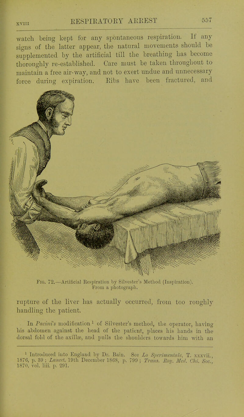 watch being kept for any spontaneous respiration. If any signs of the latter appear, the natural movements should be supplemented by the artificial till the breathing has become thoroughly re-established. Care must be taken throughout to maintain a free air-way, and not to exert undue and unnecessary force during expiration. Eibs have been fractured, and Fig. 72.—Artificial Kespiration by Silvester's Method (Inspiration). From a photograph. rupture of the liver has actually occurred, from too roughly handling the patient. In Pacini's modification ^ of Silvester's method, tlie operator, having his abdomen against the head of the patient, places his hands in the dorsal fold of the axillte, and pulls the shoulders towards him with an 1 Introduced into England by Dr. Bain. See Lo Sjmrimenlale, T. xxxvii., 1876, p. 39 ; Lancet, 19th December 1S6S, p. 799 ; Trans. Hoy. Med. Chi. Soc. 1870, vol. liii. p. 291.
