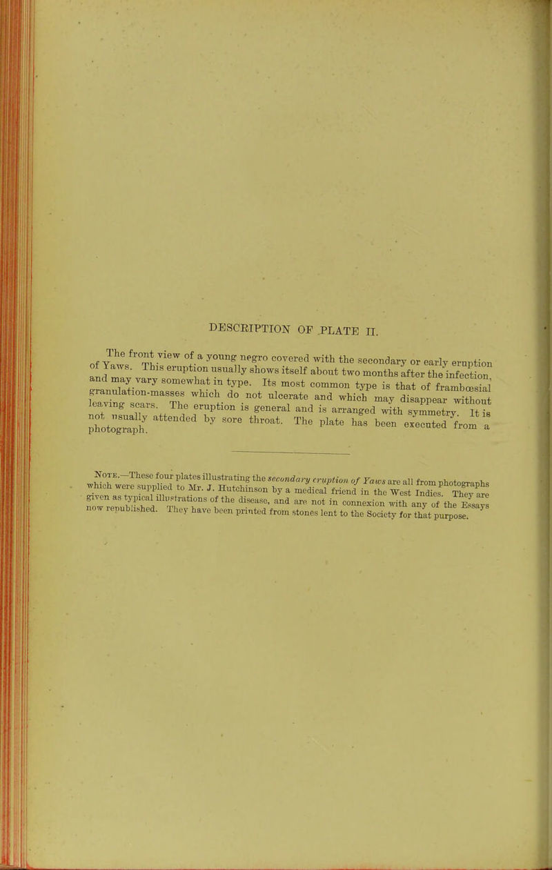 DESCRIPTION OF PLATE II. of f^o'^* ^lew of a young negro covered with the secondary or early ernntion an Jr ^-Pt--^--ally shows itself about two months iter the infect on and may vary somewhat in type. Its most common type is that of frambS wt sa;rThe''1-'°-°* ^^'T*^ '''' ^^^^ disappear ^^thou leaving scais. The eruption is general and is arranged with svmmetrv It i« lttZ:Z ' '''^ ''^'^ ernlt^rom a NoTE.-These four plates illustrating the secondary eruption of Taws are all from T,hntoo^.^>,c which were suppHed to Mr. J. Hutchinson by a medical friend in the Wes JXes ThTv ate ^von as typical ilh,.trations of the disease, and are not in connexion ^S a^y of thfETsaJ now repubhshed. They have been printed from stones lent to the Societv for that pu^ose '^