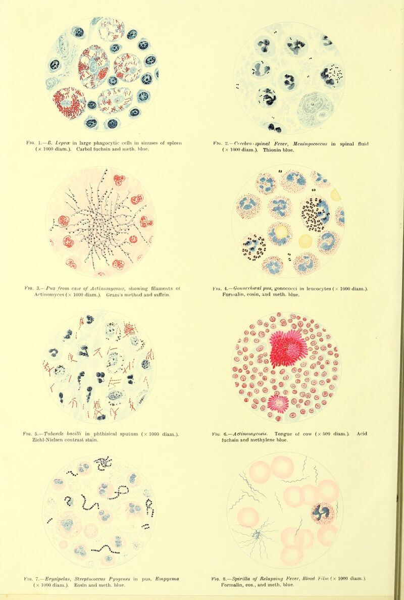 Fig. 1.—B. Lepra; in large phagocytio cells in sinuses of spleen (x lOOn diam.). Carbol fuchsin and nieth. blue. H'iG. 3.- I'lis from case of Actinomycosis, showing filamejits of Artinoniyces (x 1000 diam,). Gram s nietliod and saffrin. Fia. S.—Tubercle bacilli in phthisical sputum (xlOOO diam.). Ziehl-Nielsen contrast stain. H'lu. 'i.—Cf rebro - spinal Fever, Meningococcus in spinal fluid (X 1000 diam.). Thionin blue. KiG 6.—Actinoinucunis. Tongue of cow (x 500 diam.). Acid fuchsin and methylene blue. FiH. 7.—Erysipelas, Streptococcus Pyogenes in pus, Empyema (x 1000 diam.). Eosin and meth. blue. Mg. Spirilla of Relapsing Fever, Blood hUin (x 1000 diam.). Formalin, eos., and meth. blue.