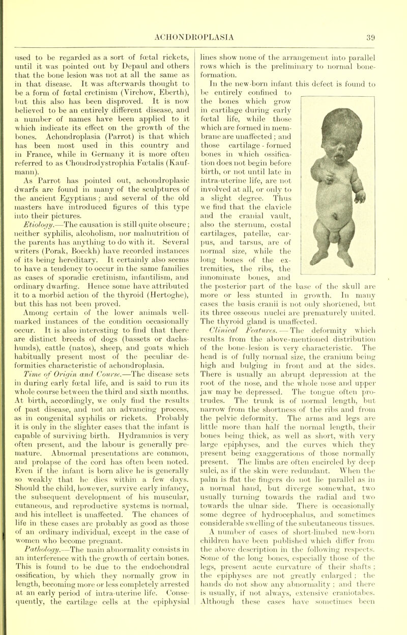used to be regarded as a sort of fa^tal rickets, until it was pointed out by Depaul and others that the bone lesion was not at all the same as in that disease. It was afterwards thougiit to be a form of foetal cretinism (Virchow, Eberth), l)ut this also has been disproved. It is now believed to be an entii'ely different disease, and a number of names have been applied to it which indicate its effect on the growth of the bones. Achondroplasia (Parrot) is that which has been most used in this country and in France, while in (lermany it is more often referred to as Chondrodystrophia Fcetalis (Kauf- mann). As Parrot lias pointed out, achondroplasic dwarfs are found in many of the sculptures of the ancient Egyptians ; and several of the old masters have introduced figures of this type into their pictures. Etiology.—The causation is still quite obscure; neither syphilis, alcoholism, nor malnutrition of the parents has anything to do with it. Several writers (Porak, Boeckh) have recorded instances of its being hereditary. It certainly also seems to have a tendency to occur in the same families as cases of sporadic cretinism, infantilism, and ordinary dwarfing. Hence some have attributed it to a morbid action of the thyroid (Hertoghe), but this has not been pi-oved. Among certain of the lower animals well- marked instances of the condition occasionally occur. It is also interesting to find that there are distinct breeds of dogs (bassets or dachs- hunds), cattle (natos), sheep, and goats which habitually present most of the peculiar de- formities characteristic of achondroplasia. Time of Origin and Course.—The disease sets in during early foetal life, and is said to run its whole course between the third and sixth months. At l)irtli, accordingly, we only find tlie results of past disease, and not an advancing process, as in congenital syphilis or rickets. Probably it is only in the slighter cases that the infant is capable of surviving birth. Hydranmios is very often present, and the labour is generally pre- mature. Abnormal jjreseutations are common, and prolapse of the cord has often been noted. Even if the infant is born alive he is generally so weakly that he dies within a few days. Should the child, however, survive early infancy, the subsequent development of his muscular, cutaneous, and reproductive systems is normal, and his intellect is unaffected. The chances of life in these cases are probably as good as those of an ordinary individual, except in the case of women who become pregnant. Pathology.—The main abnormality consists in an interference with the growth of certain bones. 'I'iiis is found to be due to the endochondral ossification, by which they normally grow in length, V)ecoming more or less completely arrested at an early period of intra-uterine life. Conse- (juently, the cartilage cells at the epiphysial lines show none of the arrangement into parallel rows which is the preliminary to normal bone- formation. In the new-born infant this defect is found to be entirely confined to the bones which grow in cartilage during early foetal life, wliile those which are formed in mem- brane are unaffected; and those cartilage - formed bones in which ossifica- tion does not begin before birth, or not until late in intra uterine life, are not involved at all, or only to a slight degree. Thus we find that the clavicle and the cranial vault, also the sternum, costal cartilages, patelhe, car- pus, and tarsus, are of normal size, while the long bones of the ex- tremities, the ribs, the innominate bones, and the jjosterior part of the base of the skull are more or less stunted in growth. In many cases the basis cranii is not only shortened, but its three osseous nuclei are prematurely united. The thyroid gland is unaffected. Clinical Features. — The deformity which results from the above-mentioned distribution of the bone-lesion is very characteristic. The head is of fully normal size, the cranium being high and bulging in front and at the sides. There is usually an abrupt depression at the root of the nose, and the whole nose and upper jaw may be depressed. The tongue often pro- trudes. The trunk is of normal length, but narrow from the shortness of the ribs and from the pelvic deformity. The arms and legs ai'e little more than half the normal length, their bones lieing thick, as well as short, with veiy large epiphyses, and the curves which they present being exaggerations of those normally present. The limbs are often encircled by deep sulci, as if the skin were redundant. When the palm is flat the fingers do not lie parallel as in a normal hand, but diverge somewhat, two usually turning towards the radial and two towards the ulnar side. Tiiere is occasionally some degree of hydrocephalus, and sometimes considerable swelling of the subcutaneous tissues. A number of cases of short-linibcd ncw-l)Oi'n children have been published which differ from the above description in the following I'espects. Sojue of the long bones, especially those of the legs, present acute curvattire of their shafts ; the epiphyses are not greatly enlarged ; the hands do not show any almormality ; and there is usually, if not always, extensive craniotabes. Althouiih these cases have sometimes been