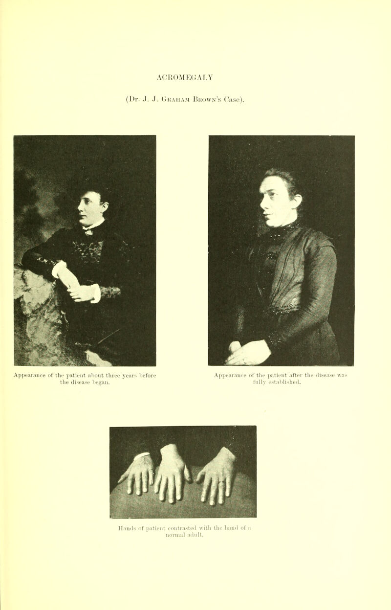 A(jromk(;aly (Dr. .1. J. (Jkaiiam liudWN'.s Case). Hauils of putiriit c-iiiilrasteil witli tljt.' liaml ot a iioiiaal aihilt.