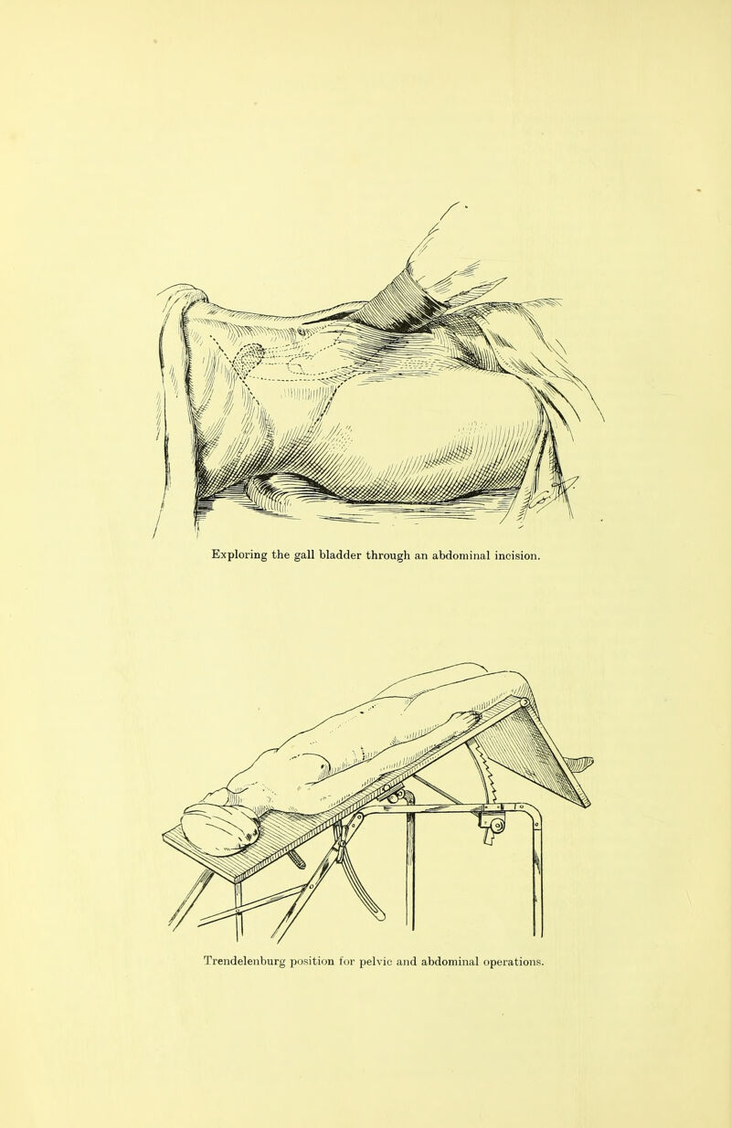 Exploring the gall bladder through an abdominal incision. Trendelenburg position for pelvic and abdominal operations.