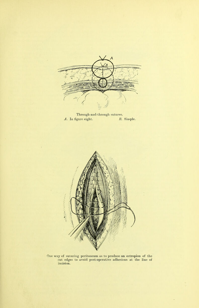 Through-and-through sutures. One way of suturing peritoneum as to produce an ectropion of the cut edges to avoid post-operative adhesions at the line of incision.