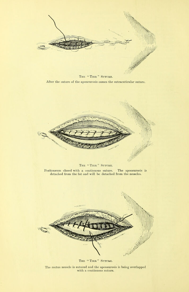 The Tier Sutuee. After the suture of the aponeurosis conies the sutracuticular suture. The Tier Suture. Peritoneum closed with a continuous suture. The aponeurosis is detached from the fat and will be detached from the muscles. The Tier Suture. The rectus muscle is sutured and the aponeurosis is being overlapped witli a continuous suture.