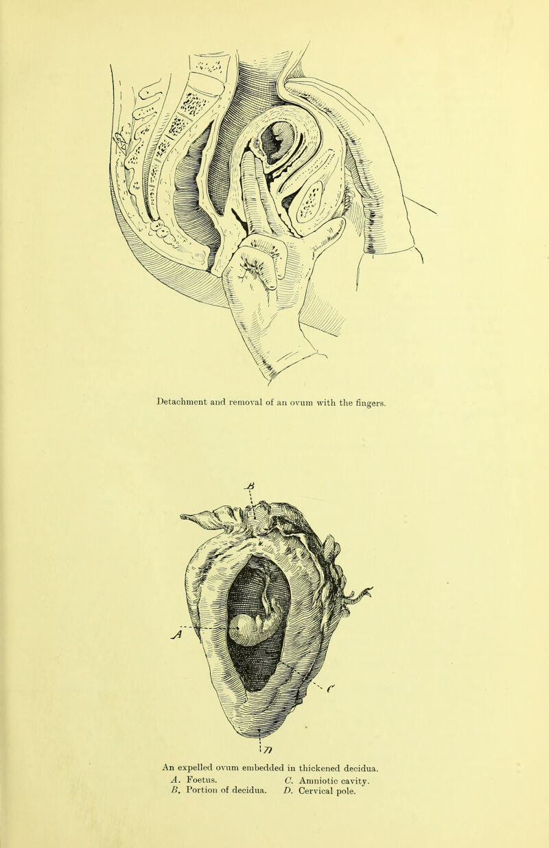 Detachment and removal of an ovum with the fingers. An expelled ovum embedded in thickened decidua. A. Foetus. C. Amniotic cavity. B, Portion of decidua. D. Cervical pole.