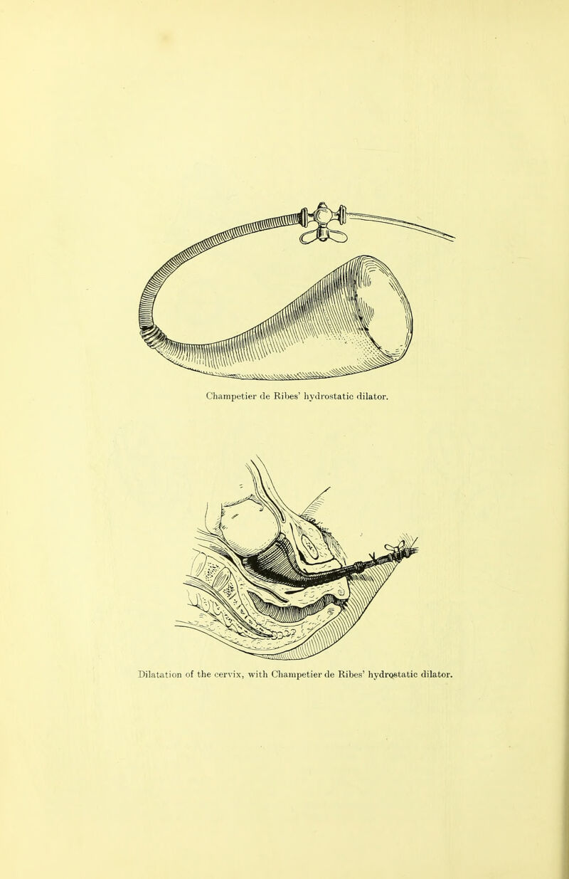Dilatation of the cervix, with Champetier de Ribes' hydrostatic dilator.
