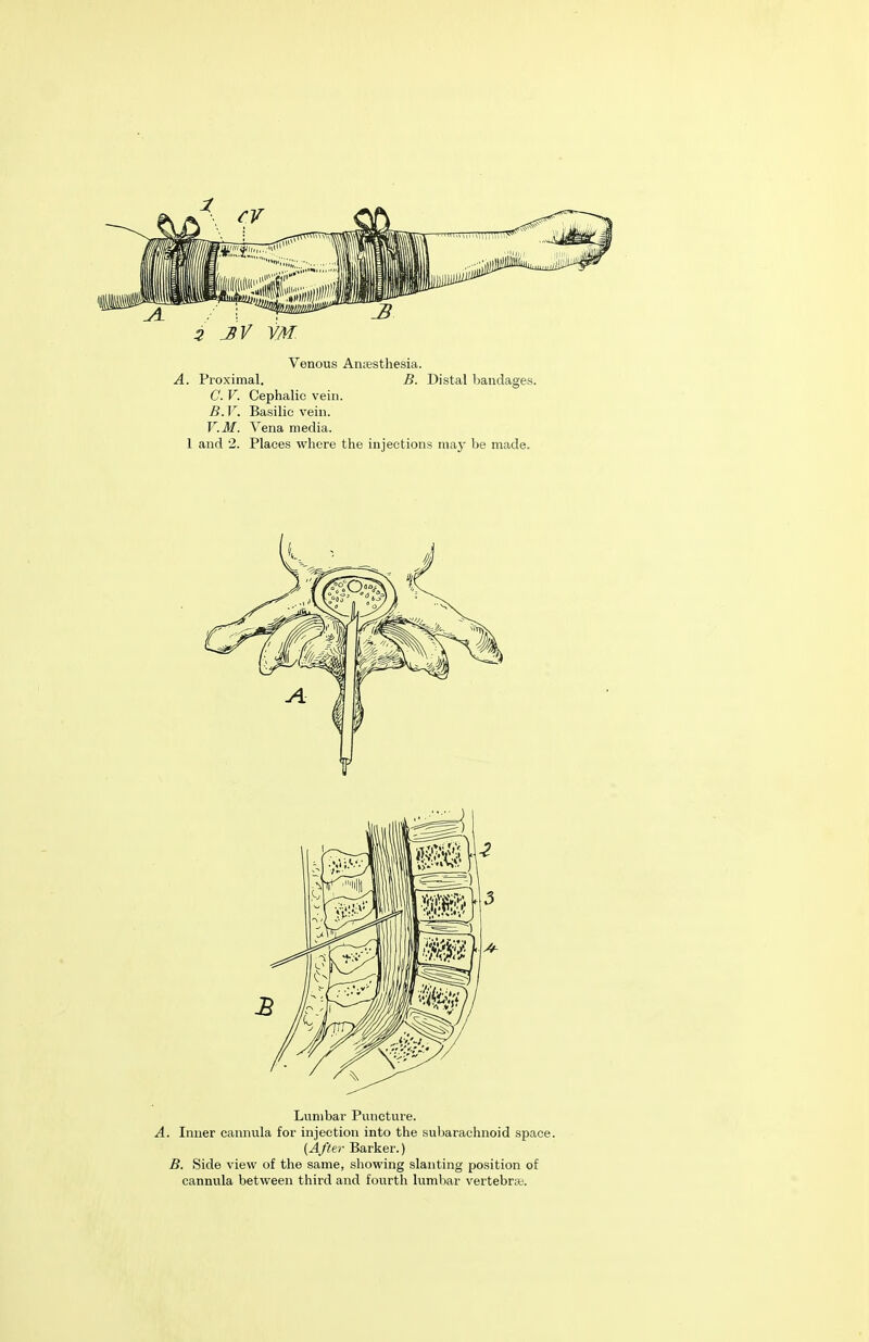 Venous Ana;sthesia. A. Proximal. B. Distal bandages. C. V. Cephalic vein. B.V, Basilic vein. V.M. Vena media. 1 and 2. Places where the injections niaj^ be made. Lumbar Puncture. . Inner cannula for injection into the subarachnoid space. {Afte7' Barker.) B. Side view of the same, showing slanting position of cannula between third and fourth lumbar vertebrse.