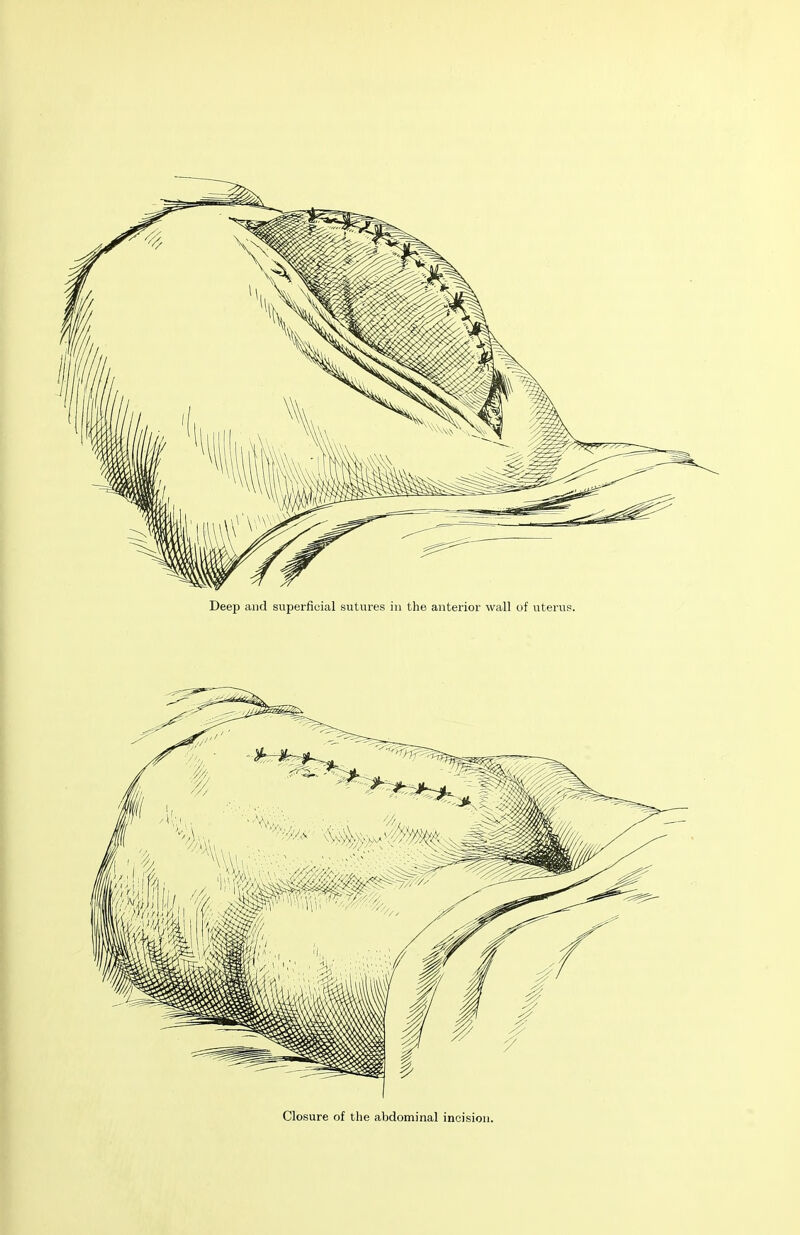 Closure of the abdominal incision.