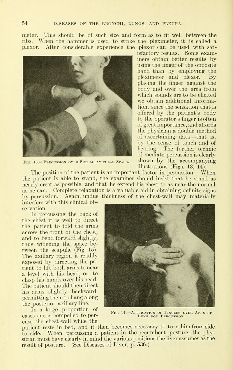 Fig. 13.—Percussion ovf.r Supraclavicular Space. meter. This should be of such size and form as to fit well between the ribs. When the hammer is used to strike the pleximeter, it is called a plexor. After considerable experience the plexor can be used with sat- isfactory results. Some exam- iners obtain better results by using the finger of the opposite hand than by employing the pleximeter and plexor. By placing the finger against the body and over the area from which sounds are to be elicited we obtain additional informa- tion, since the sensation that is offered b)'^ the patient's body to the operator's finger is often of great importance, and affords the physician a double method of ascertaining data—that is, by the sense of touch and of hearing. The further technic of mediate percussion is clearly shown by the accompanying illustrations (Figs. 13, 14). The position of the patient is an important factor in percussion. When the patient is able to stand, the examiner should insist that he stand as nearly erect as possible, and that he extend his chest to as near the normal as he can. Complete relaxation is a valuable aid in obtaining definite signs by percussion. Again, undue thickness of the chest-wall may materially interfere with this clinical ob- servation. In percussing the back of the chest it is well to direct the patient to fold the arms across the front of the chest, and to bend forward slightly, thus widening the space be- tween the scapulae (Fig. 15). The axillary region is readily exposed by directing the pa- tient to lift both arms to near a level with his head, or to clasp his hands over his head. The patient should then direct his arms slightly backward, permitting them to hang along the posterior axillary line. In a large proportion of cases one is compelled to per- cuss the chest-wall while the patient rests in bed, and it then becomes necessary to turn him from side to side. When percussing a patient in the recumbent posture, the phy- sician must have clearly in mind the various positions the liver assumes as the result of posture. (See Diseases of Liver, p. 536.) Fig. 14.- -Application or Fingers over Apex of Lung for Percussion.